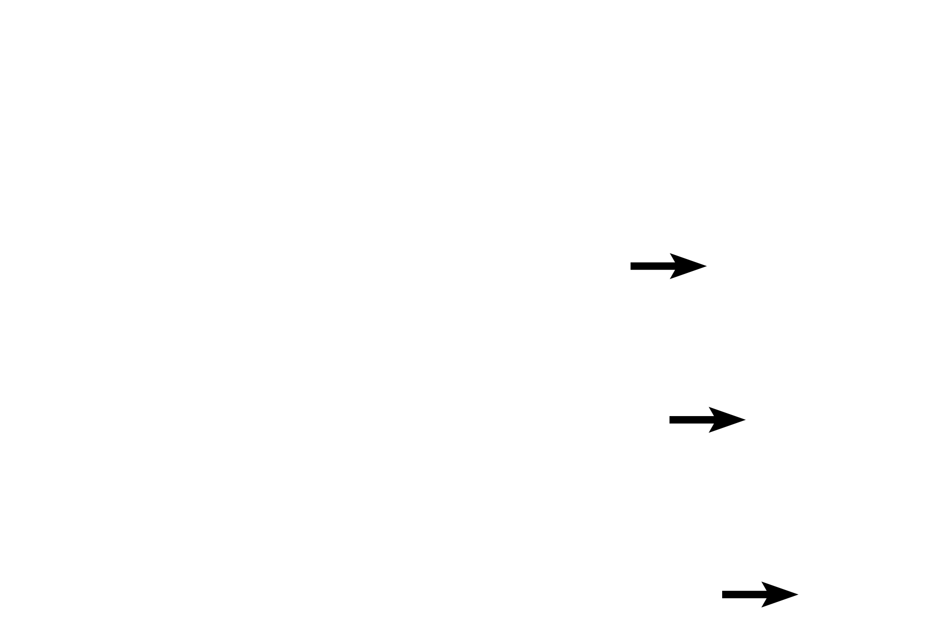 Vascular capillaries <p>Diffuse lymphoid tissue, as well as solitary and aggregated lymphoid nodules in the lamina propria, filter tissue fluid that eventually passes into lymphatic capillaries as lymph. Lymph capillaries are the blind-ended beginnings of a complex network of vessels that eventually drain through lymph nodes and into the blood vascular system. Lymph contains high levels of protein and thus the lumen of lymphatic vessels often stains pink with eosin. Esophagus 200x</p>
