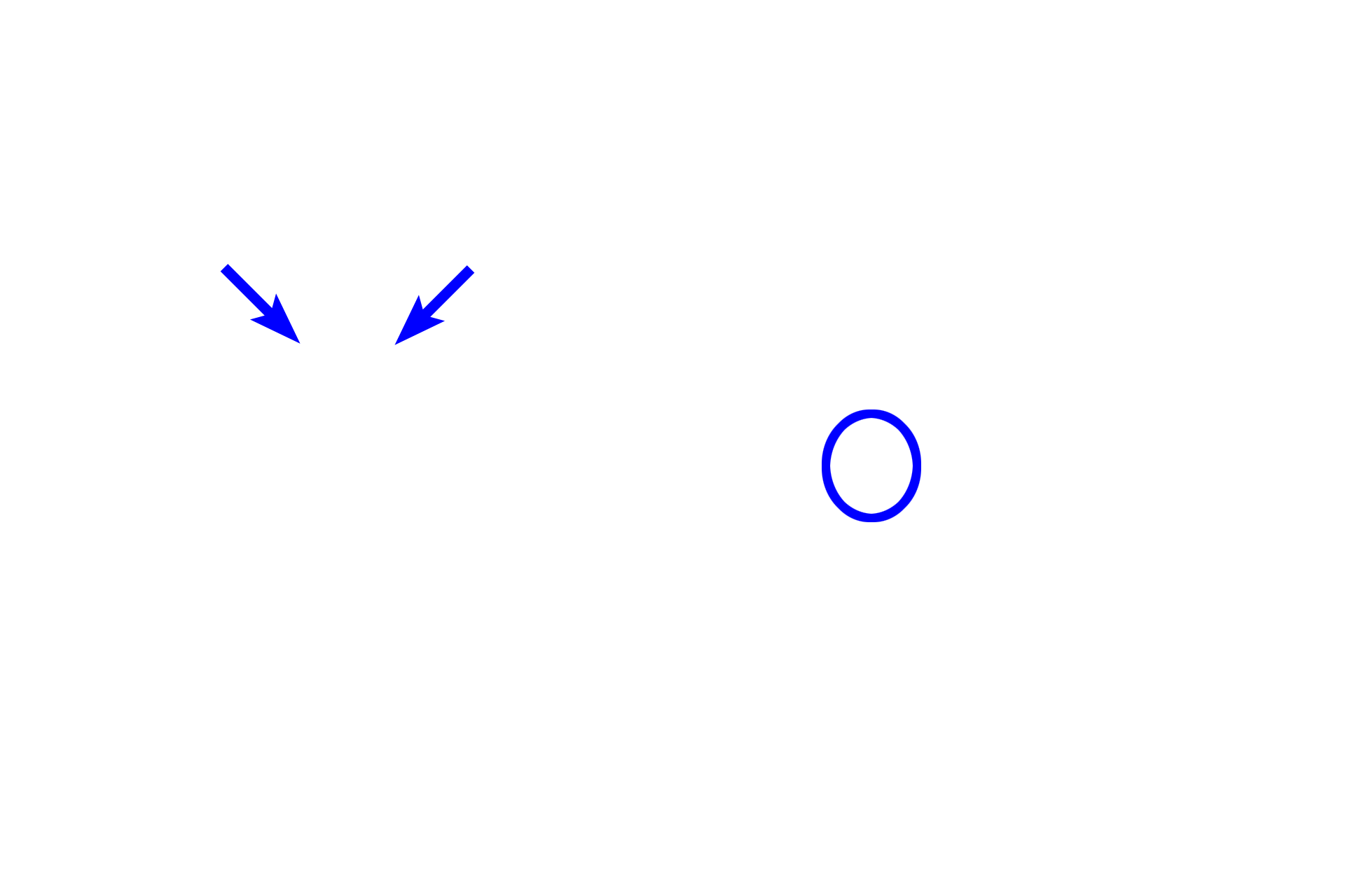  - Vocal ligament <p>Each vocal fold houses a vocalis muscle and the vocal ligament.  The vocalis muscle is skeletal muscle that alters the length and tension of the fold.  The vocal ligament is composed of dense regular elastic connective tissue and maintains tautness of the fold.  The ligament is difficult to distinguish here because elastic fibers stain similarly to collagen with eosin.  Stratified squamous moist epithelium covers the fold.  A smooth muscle layer is lacking.   </p>
