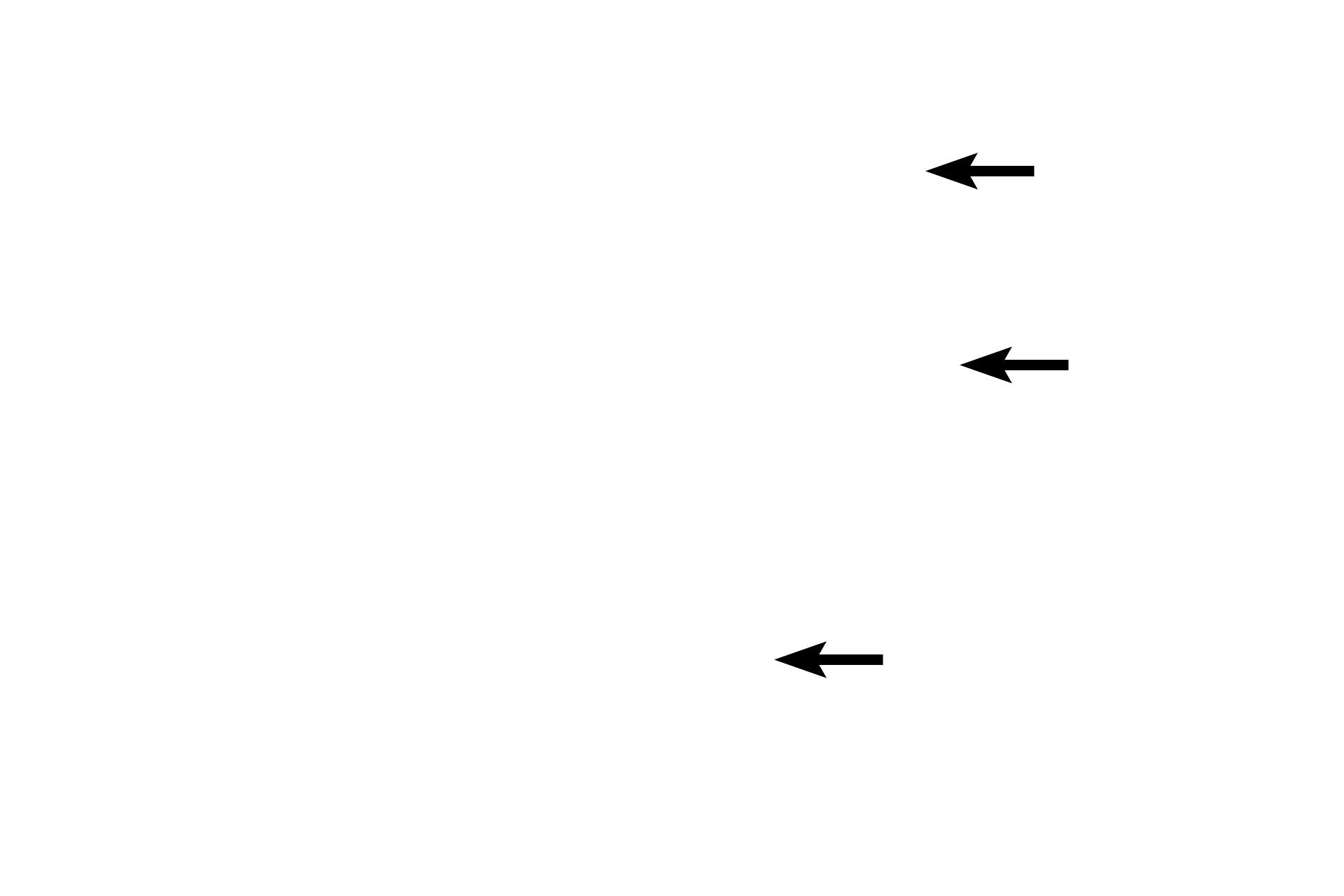 Osteoclasts <p>This spicule of bone is being resorbed by multiple osteoclasts, large, motile cells with multiple nuclei.  Throughout life, bone is resorbed and deposited to both renew and repair the matrix and to respond to mechanical stresses. Resorption results in the formation of depressions in the bone called Howship’s lacunae. Osteoclasts belong to the monocyte lineage and are not related to osteoblasts or osteocytes.  Spongy bone, 600x</p>
