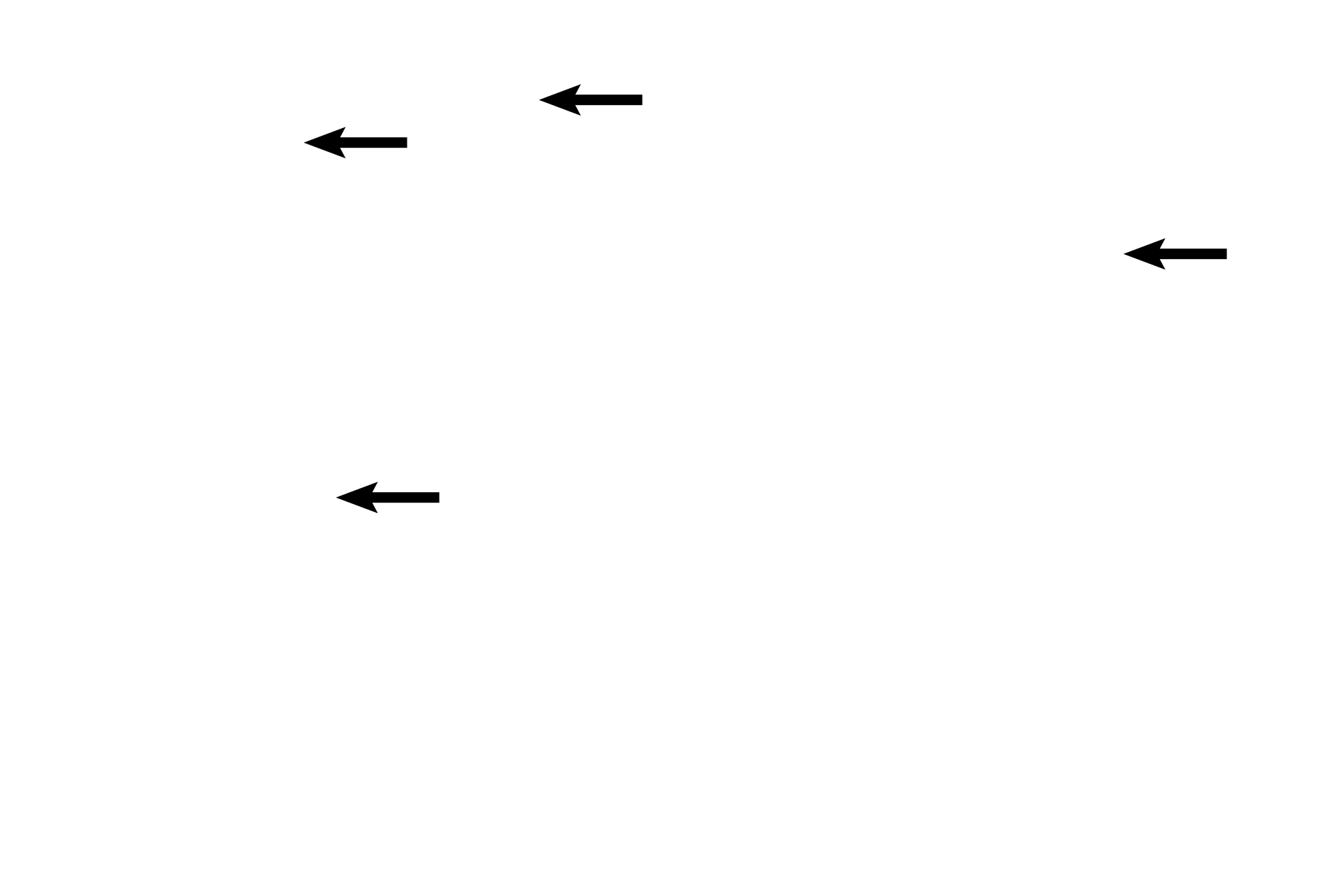 Extravasated blood <p>The sacculated glands show precipitated secretory product; areas of degeneration are obvious; extravasated blood is present in the stroma and predecidual cells can be seen beneath the surface of the organ.  The pre-menstrual phase is also known as the ischemic portion of the secretory phase.  40x </p>
