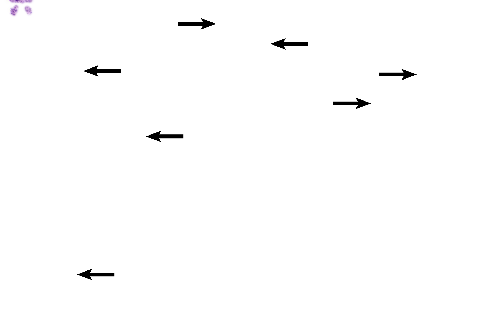 Glands >  <p>At left, sacculated glands abut the luminal surface, indicating that portions of endometrium have already been lost.  Remaining glands are sacculated and contain secretory product.  On the right all of functional zone has been lost and only bases of glands remain, from which new glands will originate.  Extravasated blood can be seen throughout the endometrium. </p>
