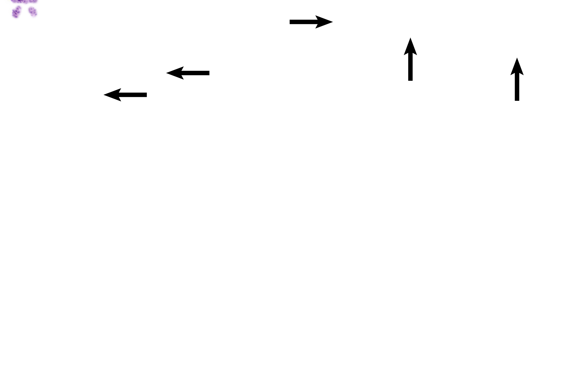 Extravasated blood <p>At left, sacculated glands abut the luminal surface, indicating that portions of endometrium have already been lost.  Remaining glands are sacculated and contain secretory product.  On the right all of functional zone has been lost and only bases of glands remain, from which new glands will originate.  Extravasated blood can be seen throughout the endometrium. </p>
