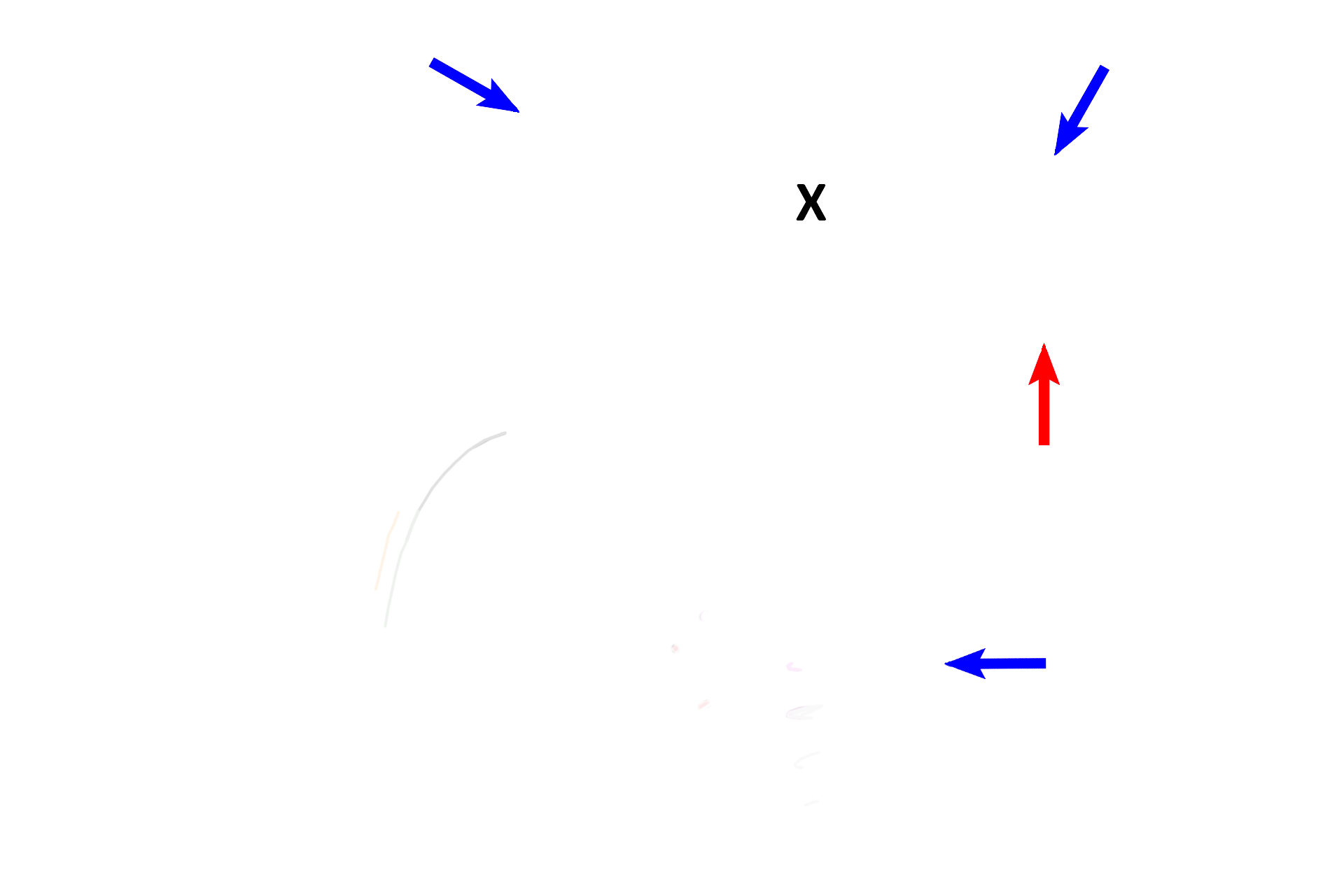  - Ductus  deferens > <p>A ductus deferens (blue arrows) continues from each duct of the epididymis, ascends through the inguinal canal, enters the peritoneal cavity and descends into the pelvis where it comes to lie posterior to the urinary bladder (X).  Near its termination the ductus deferens enlarges as the ampulla (red arrow) and is joined by the duct from a seminal vesicle.</p>
