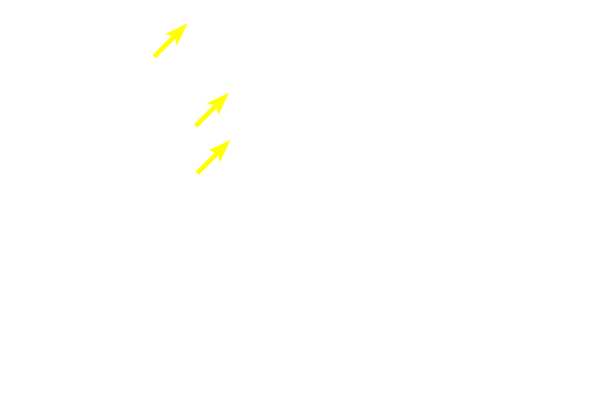 Osteoclasts <p>This bone has all the characteristics of spongy bone: anastomosing spicules, endosteal lining, and numerous blood vessels. Additionally, the numerous rounded lacunae, containing osteocytes indicate that this is woven bone. Osteoclasts are also present, demonstrating that bone resorption is occurring simultaneously.</p>
