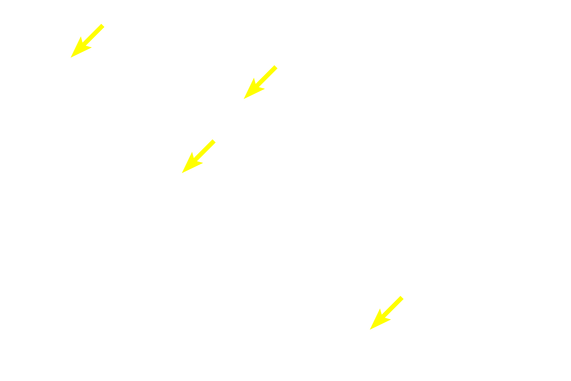 Principal cells <p>Oxyphil cells, the minor cell type found in the parathyroid gland, are diagnostic for this gland.  They can be clearly distinguished from the principal cells by their larger size and abundant, eosinophilic cytoplasm, due to large numbers of mitochondria present.  Oxyphil cells occur singly or, as seen here, in small accumulations among the chief cells.  Oxyphil cells appear at the onset of puberty; however, their function remains uncertain. 200x</p>
