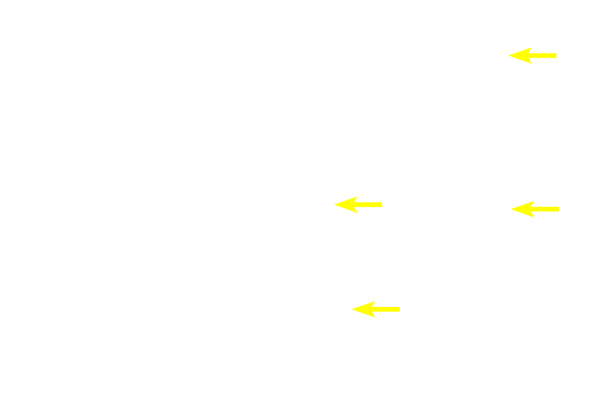 Oxyphil cells <p>Oxyphil cells, the minor cell type found in the parathyroid gland, are diagnostic for this gland.  They can be clearly distinguished from the principal cells by their larger size and abundant, eosinophilic cytoplasm, due to large numbers of mitochondria present.  Oxyphil cells occur singly or, as seen here, in small accumulations among the chief cells.  Oxyphil cells appear at the onset of puberty; however, their function remains uncertain. 200x</p>
