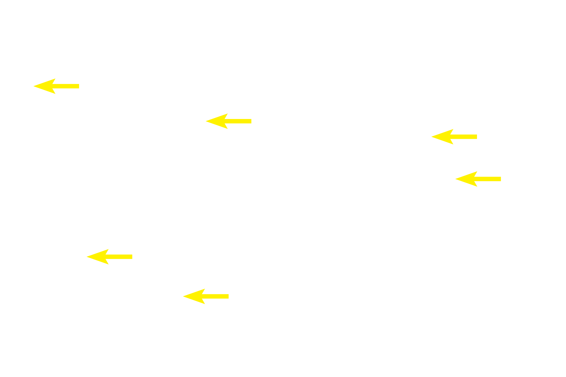 Oxyphil cells <p>The special stain used in these images clearly reveals the distribution of oxyphil cells among the more numerous principal cells. Principal cells have sparse amounts of cytoplasm and heterochromatic nuclei.  Oxyphil cells have more abundant cytoplasm, which stains reddish due to presence of large numbers of mitochondria.  400x, 1000x</p>
