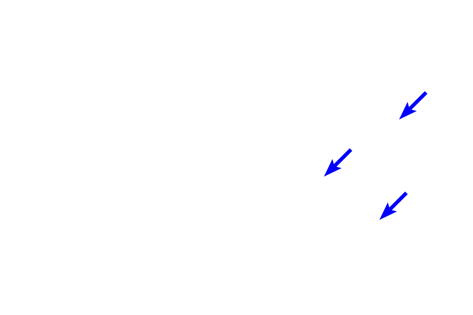  - Alpha cells <p>These images show two special histochemical stains used to distinguish among the different cell types in the islet of Langerhans.  The aldehyde fuchsin method (left) stains insulin-secreting beta cells blue.  The Gomori’s method (right) stains insulin-secreting beta cells light blue and glucagon-secreting alpha cells pink.  Beta cells comprise about 70% of the islet cells, alpha cells about 20%.  The remaining somtatostatin-secreting delta cells are not distinguished by these methods.  400x, 400x</p>
