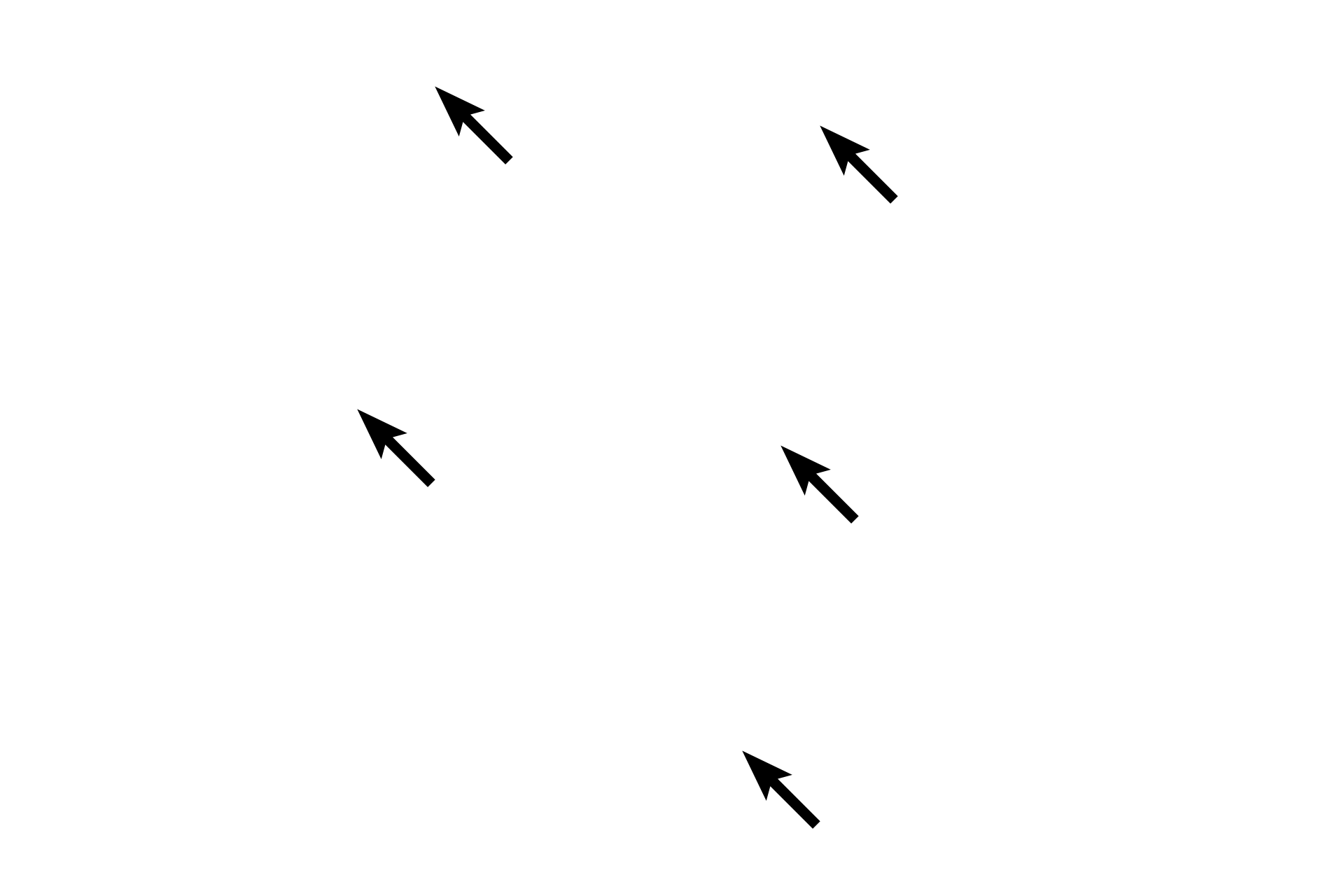 Spindle shape <p>This composite image shows the morphology of spindle-shaped smooth muscle cells.  As shown in the top panel, these cells are long, thin and taper at their ends.  The nucleus is located midway along their length.  This structure allows the cells to assemble into a tissue that forms compact sheets or layers, often forming the wall of hollow organs.  The middle panel shows smooth muscle tissue in the wall of the digestive tract, the bottom panel is an illustration of that region.  Top and middle panels 400x</p>
