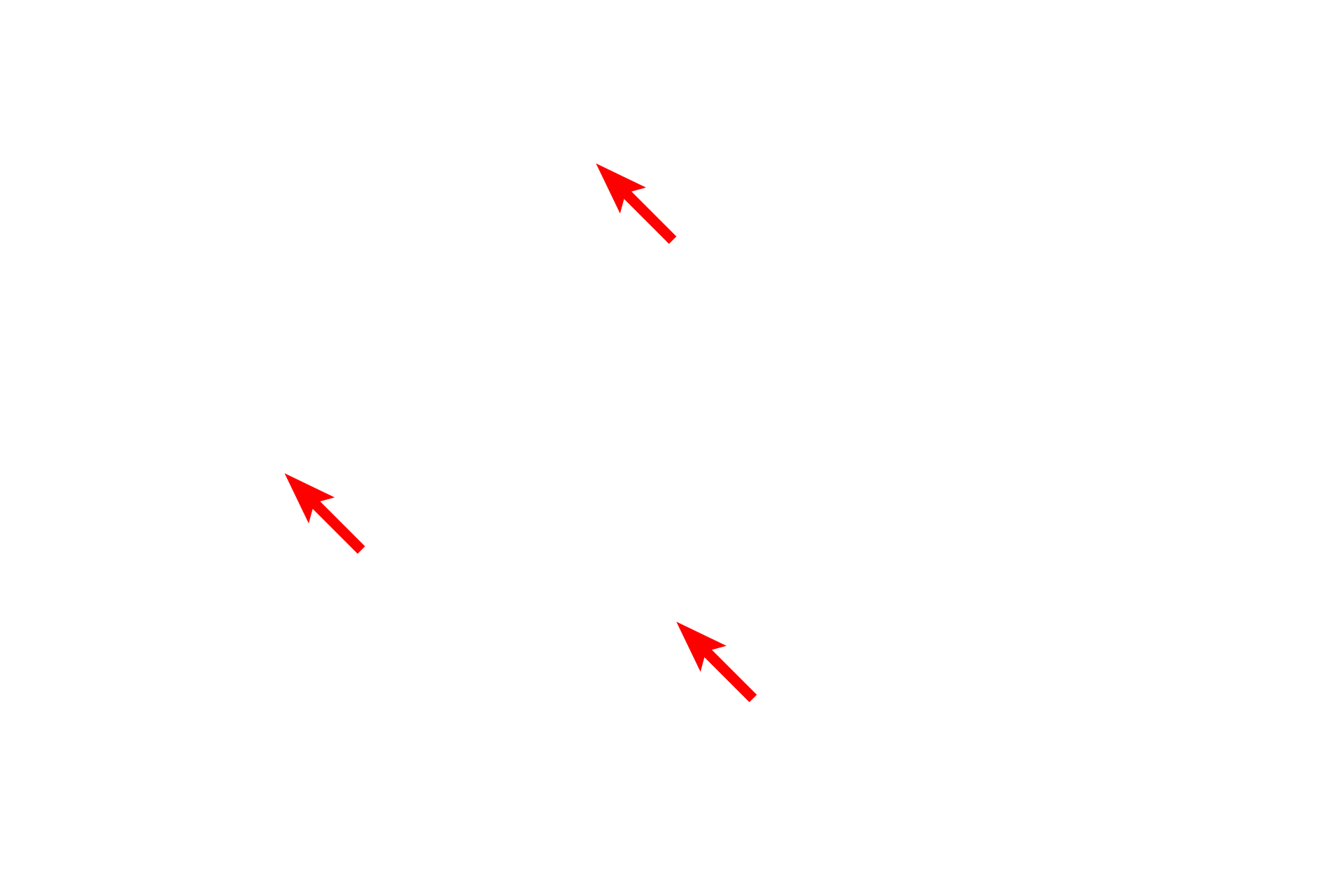  - Haversian canals > <p>Concentric lamellae surround a central space called the Haversian canal and the entire structure is a Haversian system (osteon). Haversian canals contain blood vessels and are lined by endosteum. </p>
