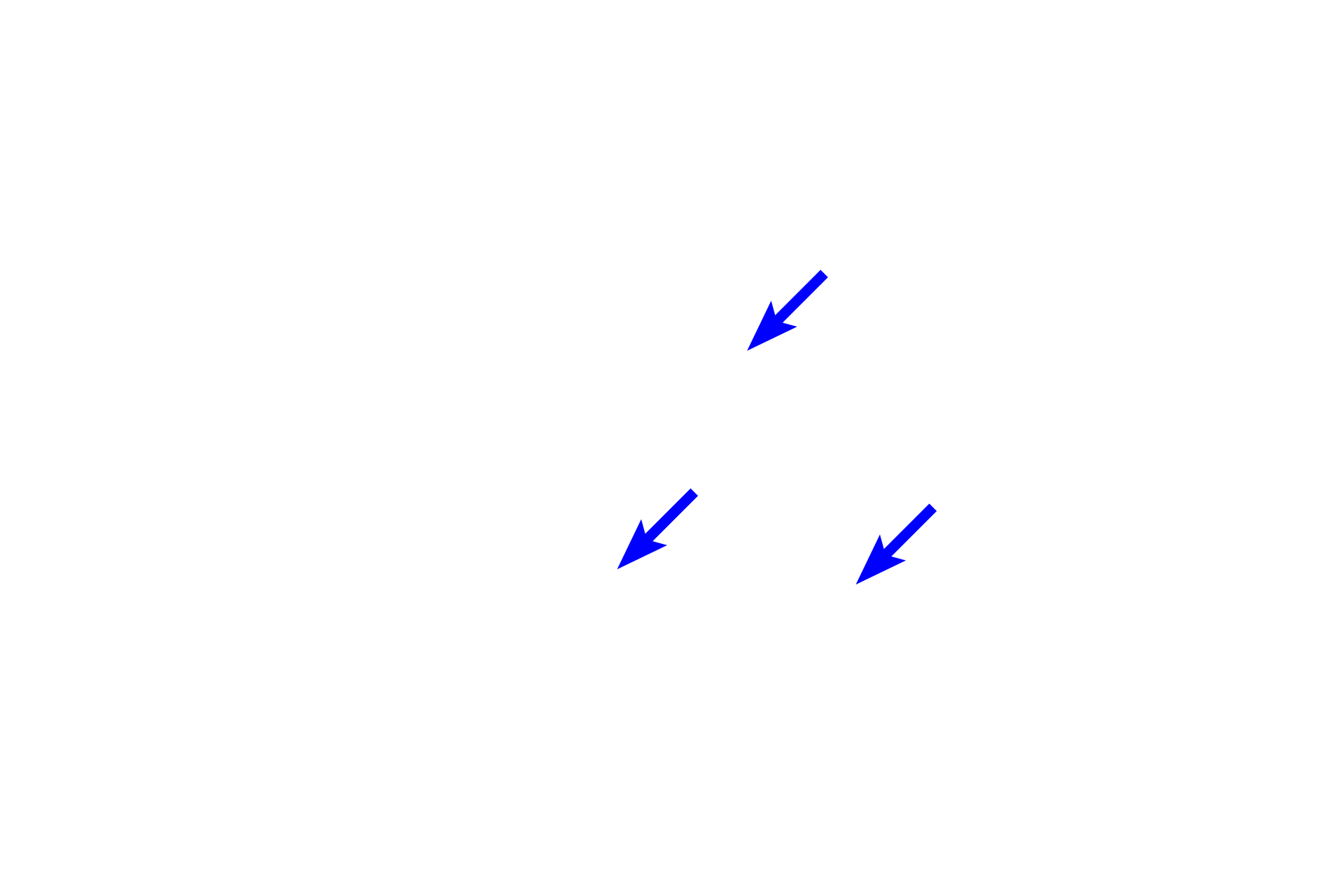  - Secretory tubule <p>This image shows apocrine and eccrine sweat glands in the axilla.  Apocrine sweat glands are large with a wide lumen and secrete a thick, protein-rich secretion by the merocrine mode.  These secretions acquire a distinctive odor by the action of bacteria on the skin surface.  The duct of an apocrine sweat gland empties into the hair follicle.  200x</p>
