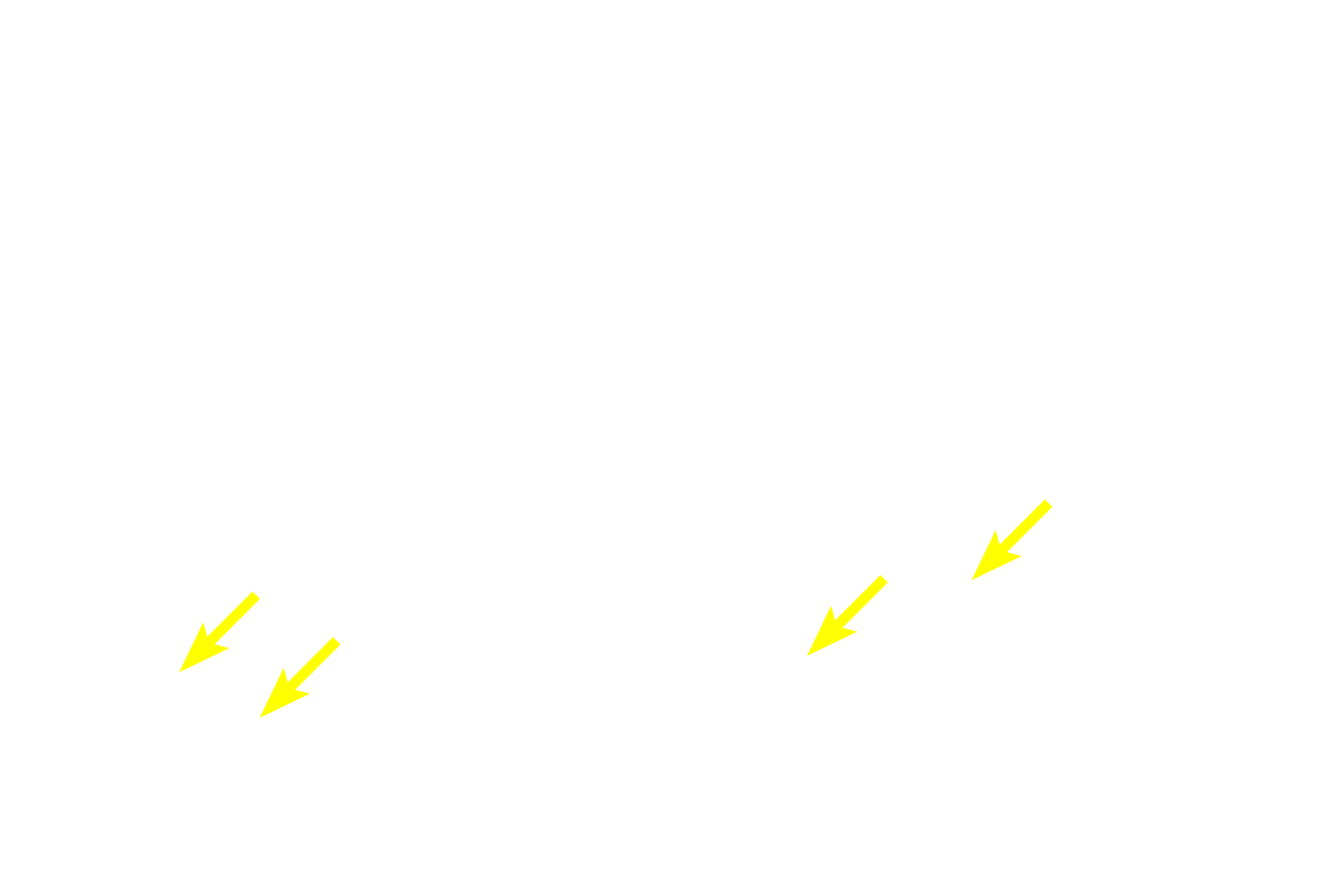  - Melanocytes <p>A second cell type present in the stratum basale is the melanocyte, which often appear to have a clear, halo-like cytoplasm around a heterochromatic nucleus.  Melanocytes synthesize melanin pigment which they package it into melanosomes that are transferred to keratinocytes, imparting an overall brownish color to the stratum basale.  Melanin absorbs ultraviolet light thereby protecting the DNA in the stratum basal cells.  Melanocytes have a different embryological origin from keratinocytes.  Also visible in the epidermis are migrating macrophages called Langerhans cells.  400x</p>
