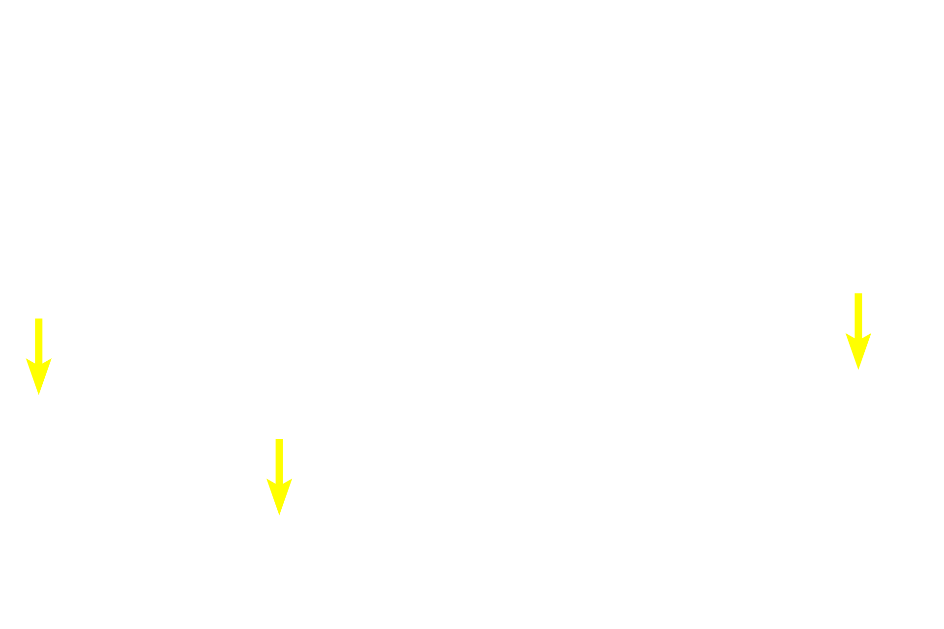  - Melanin <p>A second cell type present in the stratum basale is the melanocyte, which often appear to have a clear, halo-like cytoplasm around a heterochromatic nucleus.  Melanocytes synthesize melanin pigment which they package it into melanosomes that are transferred to keratinocytes, imparting an overall brownish color to the stratum basale.  Melanin absorbs ultraviolet light thereby protecting the DNA in the stratum basal cells.  Melanocytes have a different embryological origin from keratinocytes.  Also visible in the epidermis are migrating macrophages called Langerhans cells.  400x</p>
