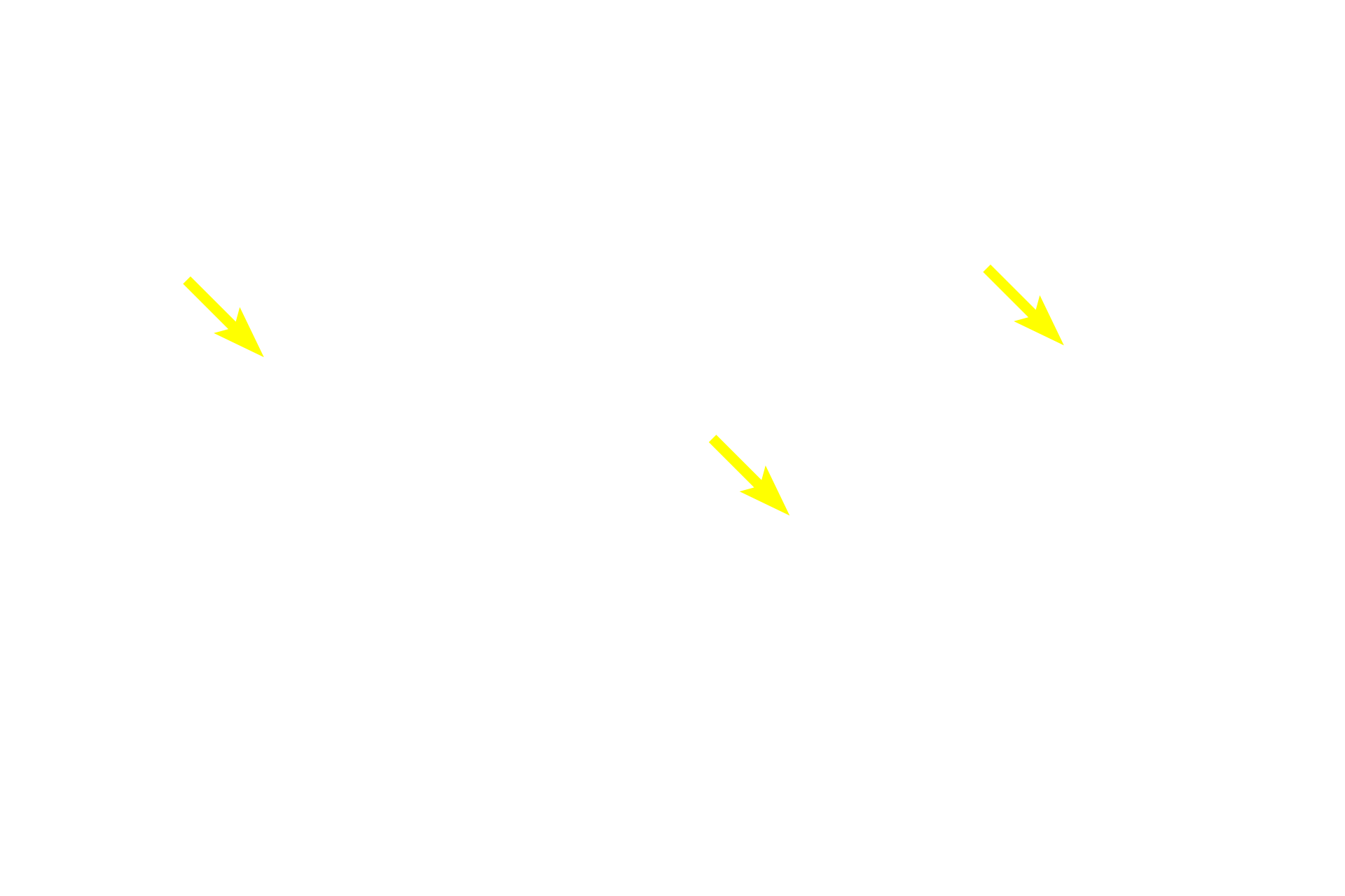 Langerhans cells <p>A second cell type present in the stratum basale is the melanocyte, which often appear to have a clear, halo-like cytoplasm around a heterochromatic nucleus.  Melanocytes synthesize melanin pigment which they package it into melanosomes that are transferred to keratinocytes, imparting an overall brownish color to the stratum basale.  Melanin absorbs ultraviolet light thereby protecting the DNA in the stratum basal cells.  Melanocytes have a different embryological origin from keratinocytes.  Also visible in the epidermis are migrating macrophages called Langerhans cells.  400x</p>
