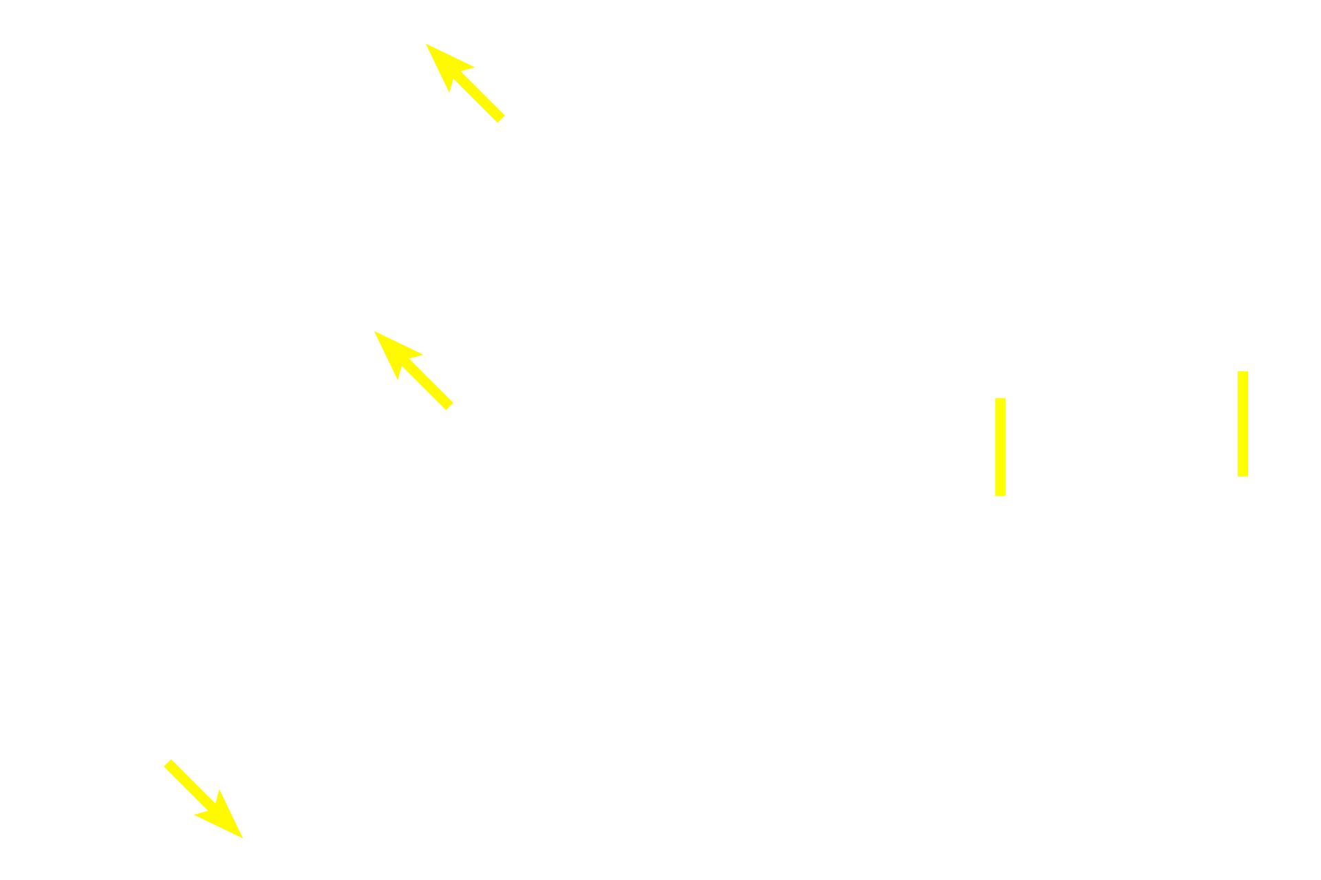 Perineurium <p>The epineurium consists of dense irregular connective tissue that surrounds the nerve and contains adipocytes as well as blood vessels.  The perineurium, produced by perineurial cells, is a specialized, metabolically active connective tissue that contributes to the blood-nerve-barrier.  The endoneurium is a product of both fibroblasts and Schwann cells and surrounds individual myelinated axons as well as Schwann cells ensheathing unmyelinated axons.  </p>

