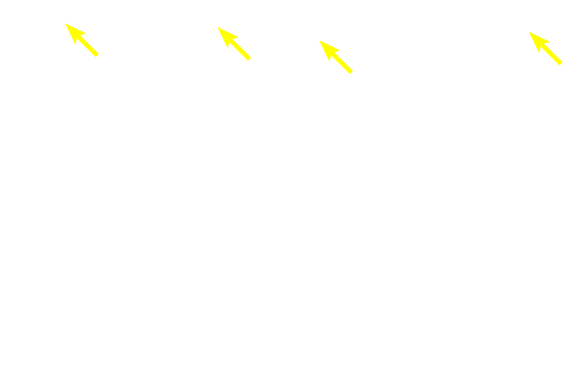  - Smooth muscle fibers <p>Because this large vein is sectioned longitudinally, the orientation of the smooth muscle fibers is reversed from that shown in the previous cross sections.  In this orientation, longitudinally-oriented smooth muscle fibers in tunicae intima and adventitia are seen in longitudinal section, and the circularly arranged smooth muscle in the tunica media is seen in cross section. This section was stained for elastic fibers, thus an internal elastic lamina, which is present in larger veins, is prominent.  100x, 250x</p>
