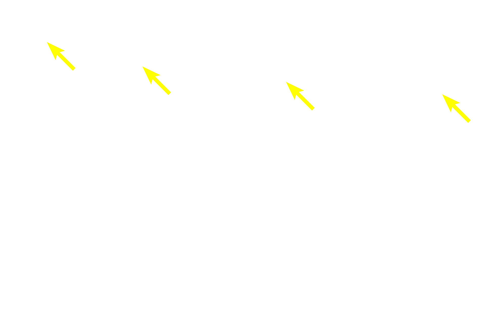  - Smooth muscle fibers <p>Because this large vein is sectioned longitudinally, the orientation of the smooth muscle fibers is reversed from that shown in the previous cross sections.  In this orientation, longitudinally-oriented smooth muscle fibers in tunicae intima and adventitia are seen in longitudinal section, and the circularly arranged smooth muscle in the tunica media is seen in cross section. This section was stained for elastic fibers, thus an internal elastic lamina, which is present in larger veins, is prominent.  100x, 250x</p>
