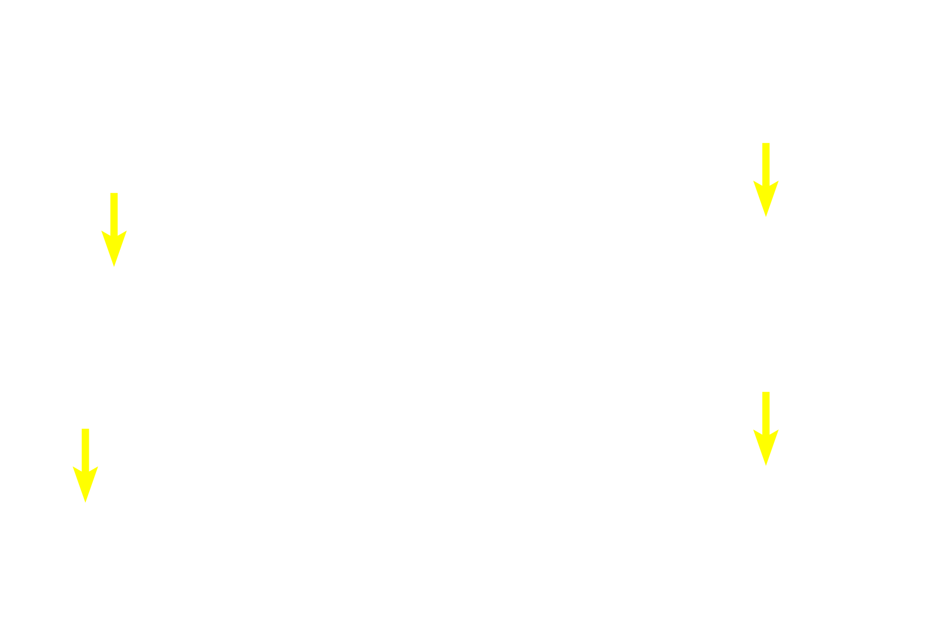 Primary spermatocytes <p>Spermatogenesis has four phases: spermatocytogenesis (mitotic division of spermatogonia to primary spermatocytes); meiosis (a two-step division of primary spermatocytes to secondary spermatocytes to spermatids); spermiogenesis (cytodifferentiation of spermatids into mature spermatozoa); and spermiation (the release of sperm from Sertoli cells). 600X</p>
