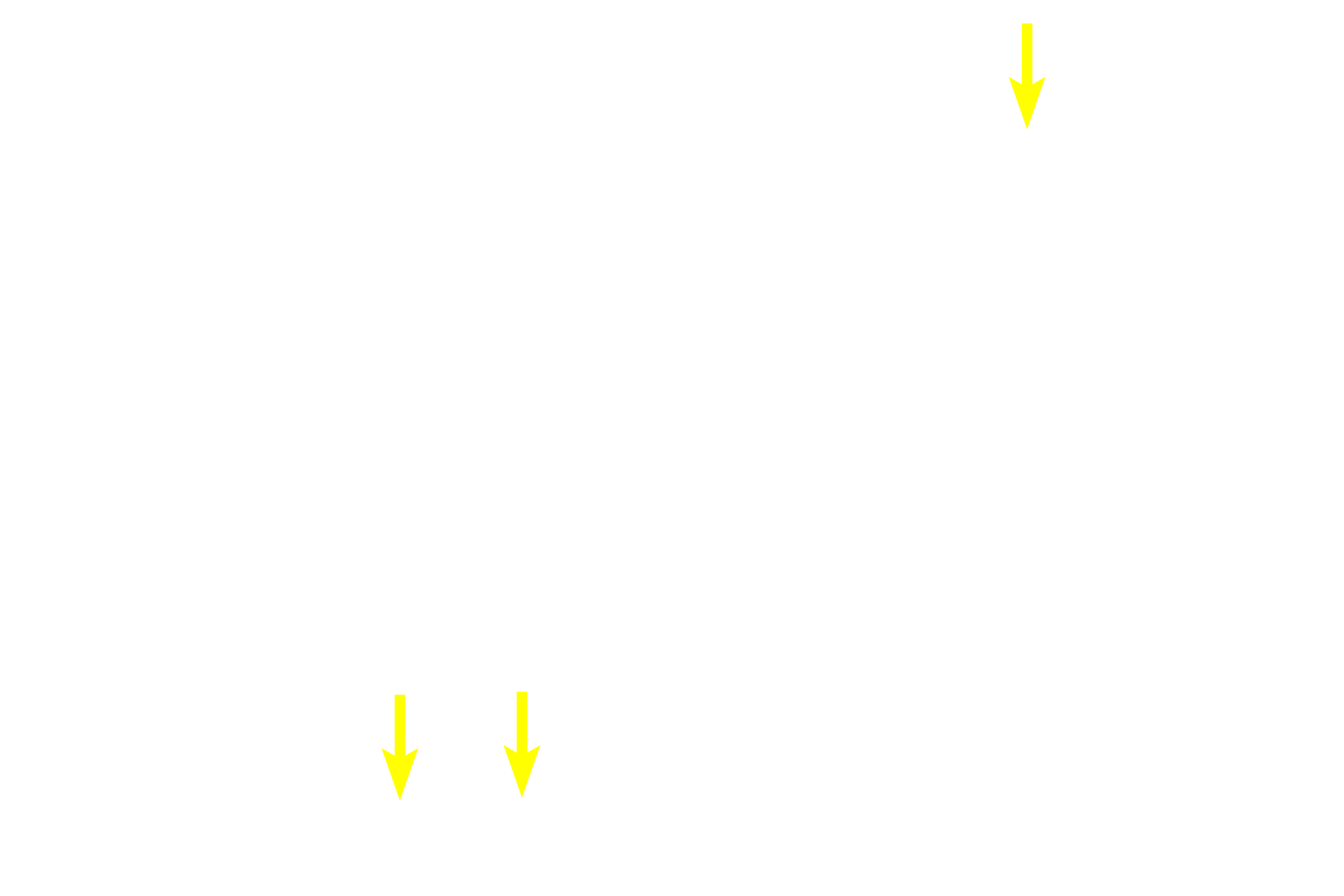 Primary spermatocytes in prophase <p>Primary spermatocytes, the largest cells in the spermatogenic lineage, form from mitotic division of spermatogonia in the basal compartment. Primaries migrate through the blood-testis barrier and enter a prolonged period of prophase of meiosis I. Primary spermatocytes complete meiosis I, the reductional phase, to produce haploid secondary spermatocytes. 1000x</p>
