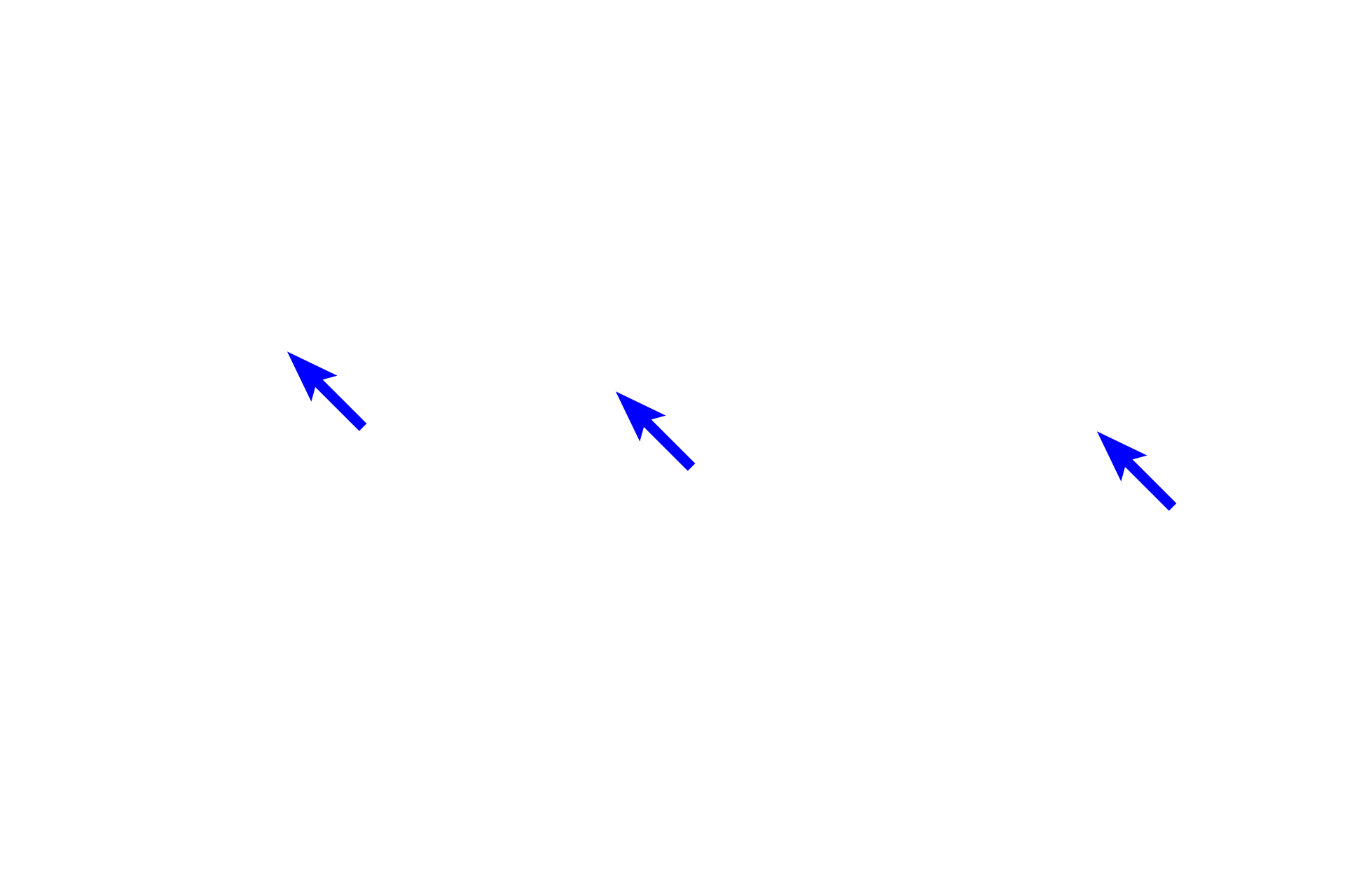 Stratum granulosum <p>There is normally an abrupt transition between the stratum granulosum and the stratum corneum.  Stratum corneum consists of non-living keratinized cells or squames that consists of a cornified cell envelope surrounding a matrix of aggregated tonofibrils. These cells are continuously shed from the surface of the epidermis and are replenished through the upward migration and ongoing keratinization of epidermal keratinocytes.  The keratin matrix accounts for the strong eosinophilic staining seen in these cells.  400x</p>
