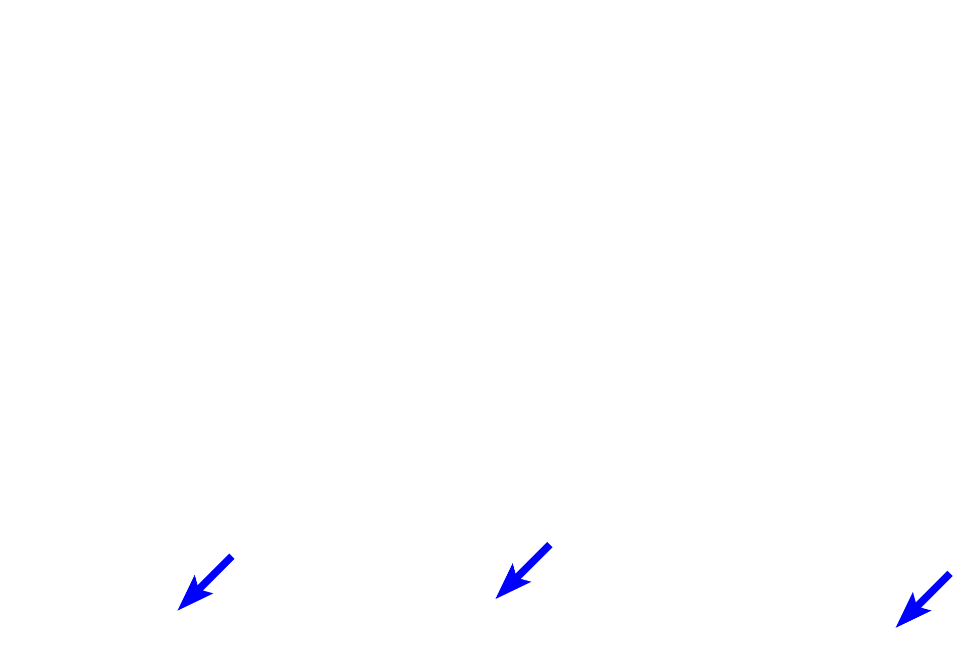 Dermis <p>There is normally an abrupt transition between the stratum granulosum and the stratum corneum.  Stratum corneum consists of non-living keratinized cells or squames that consists of a cornified cell envelope surrounding a matrix of aggregated tonofibrils. These cells are continuously shed from the surface of the epidermis and are replenished through the upward migration and ongoing keratinization of epidermal keratinocytes.  The keratin matrix accounts for the strong eosinophilic staining seen in these cells.  400x</p>
