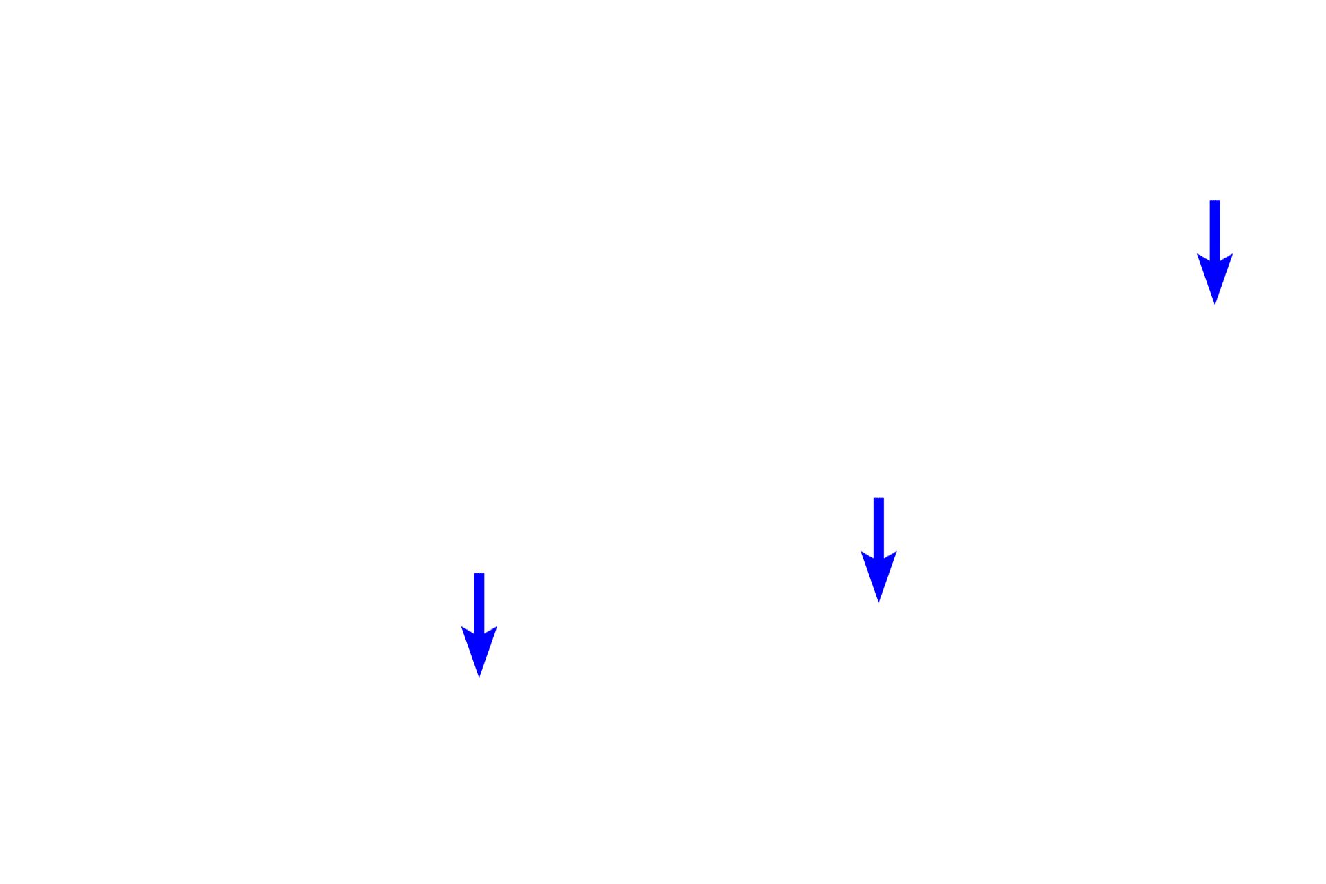  - Diffuse lymphoid tissue <p>The mucosa of the appendix resembles that of the colon; straight intestinal glands are located in the lamina propria; villi are not present.  Abundant diffuse and nodular lymphoid tissue infiltrate the appendix.  400x</p>
