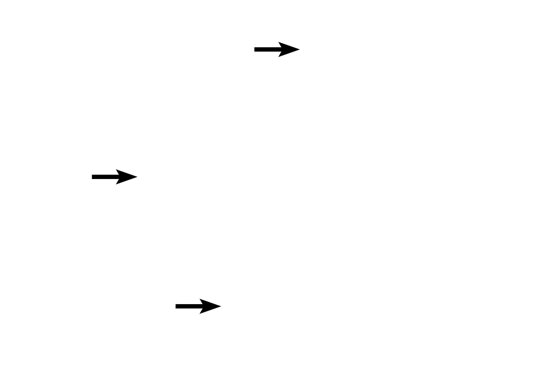 Submucosa <p>The appendix is a fingerlike appendage on the first portion of the large intestine. Like the large intestine, it also has straight intestinal glands and lacks villi. Abundant lymphoid tissue, both diffuse and nodular, occupies much of the lamina propria. Unlike the remainder of the large intestine, the appendix has a complete outer longitudinal muscle layer, thus lacking taeniae coli. The appendix is covered by a serosa.  100x</p>
