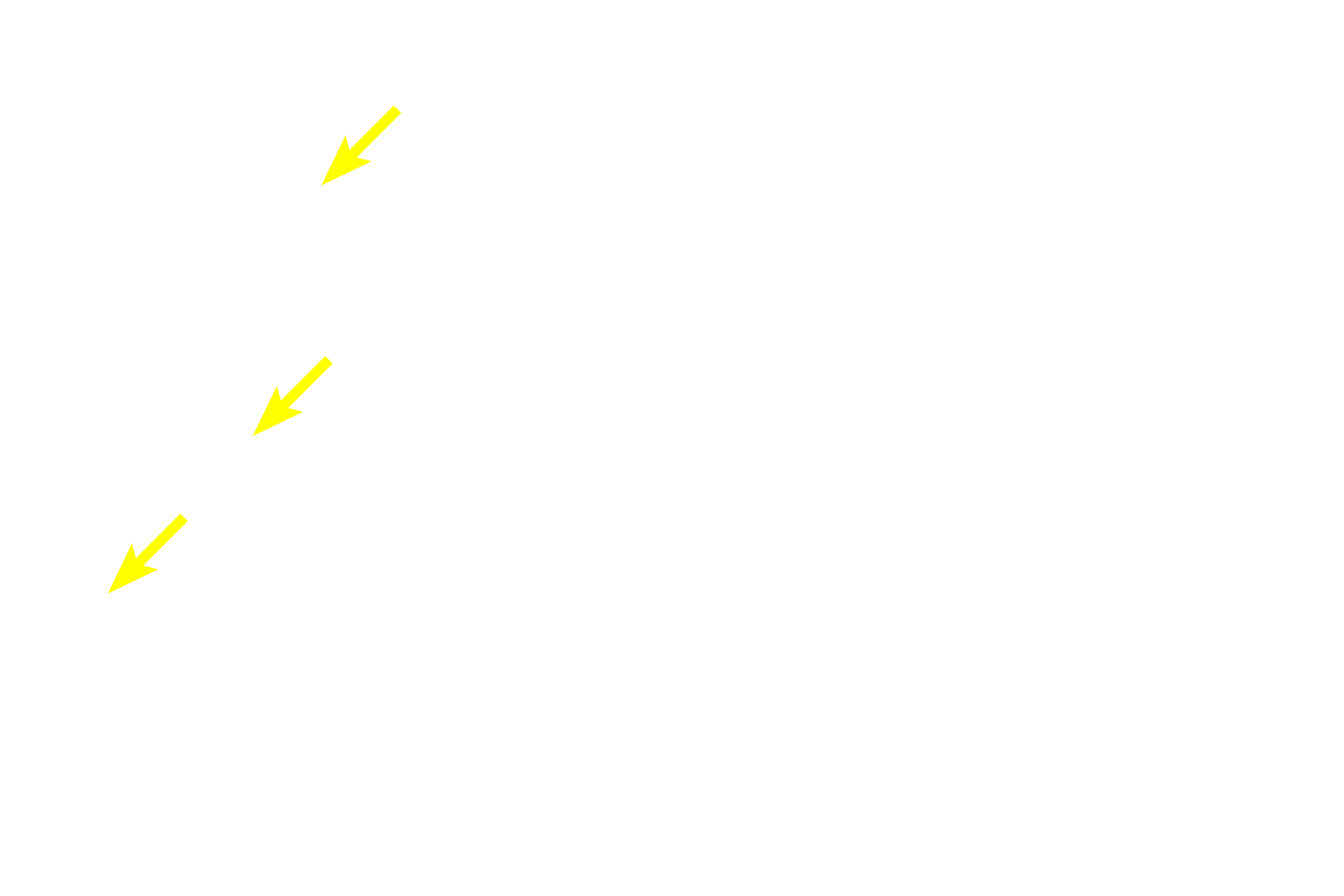 Diffuse lymphoid tissue > <p>Diffuse lymphoid tissue consists of dispersed lymphoid cells (B and T lymphocytes, macrophages and plasma cells) in the lamina propria.  </p>
