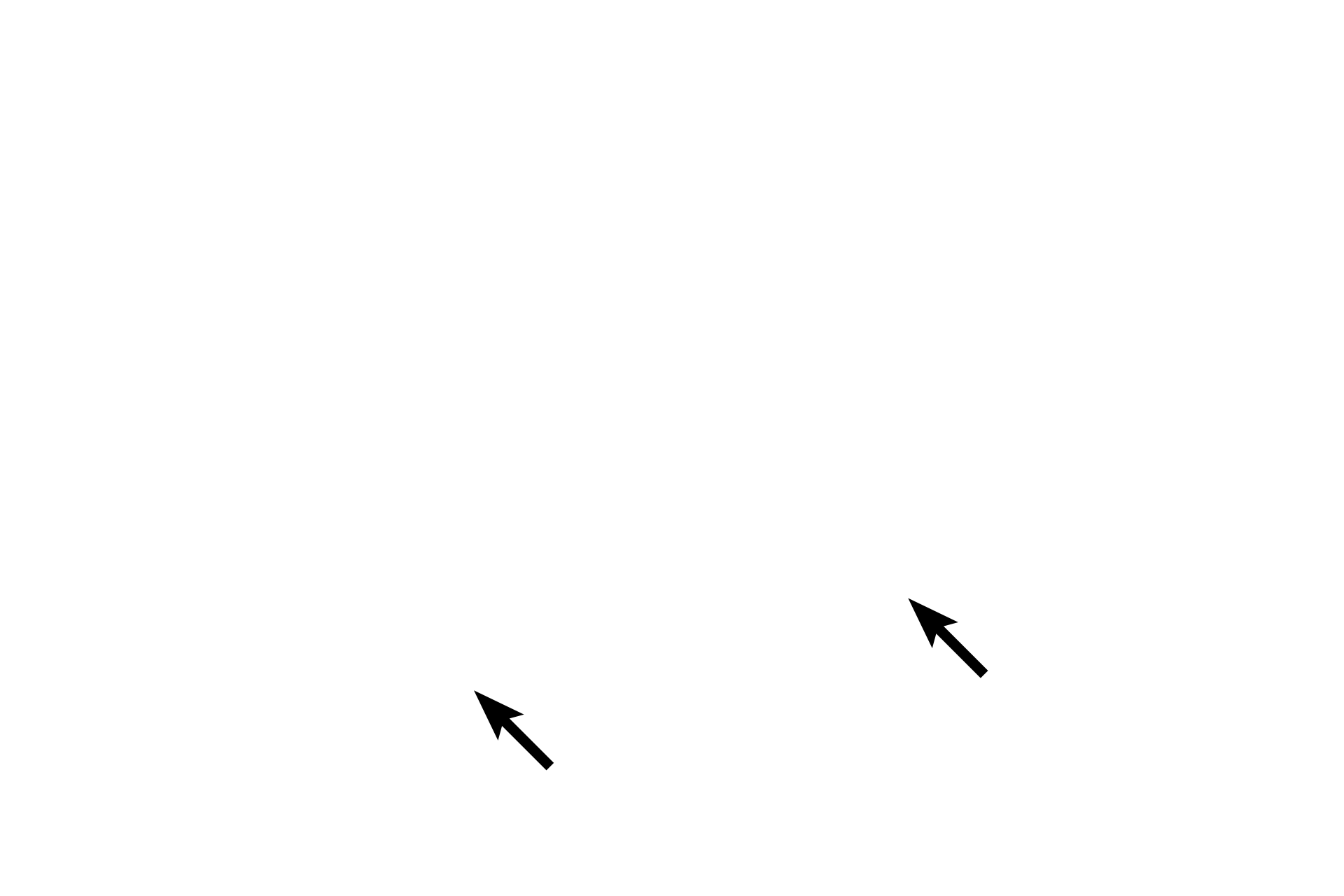 Tunica vaginalis - visceral layer <p>The processes vaginalis is a remnant of the peritoneal space that precedes the testis during its descent into the scrotum.  The space is lined by the tunica vaginalis, a serous membrane, with visceral and parietal layers.  Like all serosas, the tunica vaginalis is composed of connective tissue covered by a mesothelium (simple squamous epithelium). The parietal layer lines the inner surface of the scrotum; the visceral layer covers the tunica albuginea, the dense connective tissue surrounding the testis proper. Immature testis, 100x</p>
