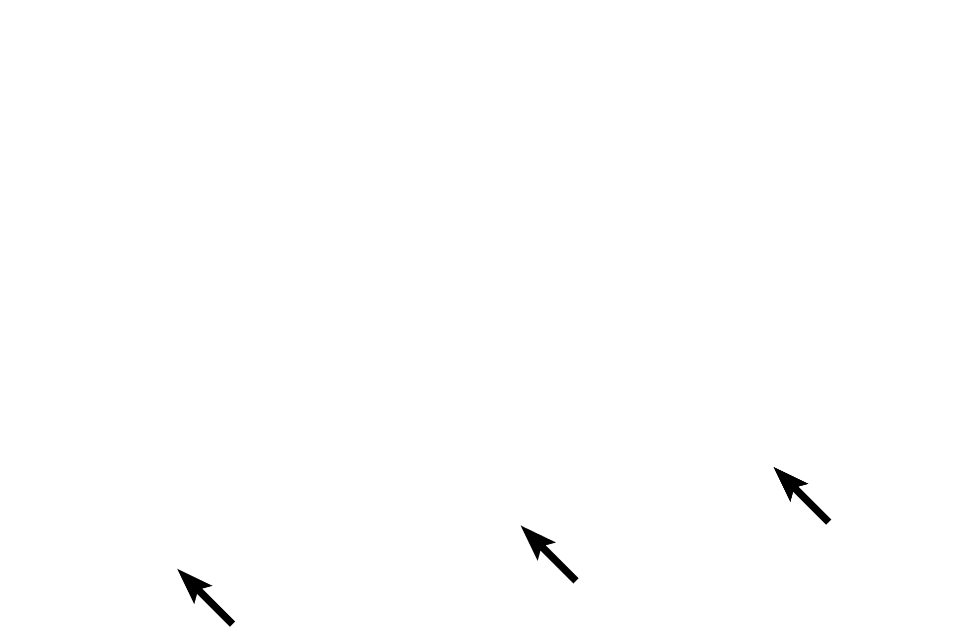 Scrotum <p>The processes vaginalis is a remnant of the peritoneal space that precedes the testis during its descent into the scrotum.  The space is lined by the tunica vaginalis, a serous membrane, with visceral and parietal layers.  Like all serosas, the tunica vaginalis is composed of connective tissue covered by a mesothelium (simple squamous epithelium). The parietal layer lines the inner surface of the scrotum; the visceral layer covers the tunica albuginea, the dense connective tissue surrounding the testis proper. Immature testis, 100x</p>
