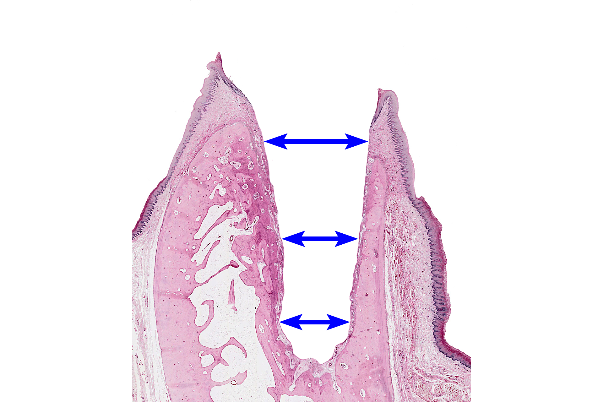 Dental alveolus > <p>The dental alveolus is a bony socket that holds the tooth.  Dental alveoli are located in the maxilla and mandible.  All alveolar bone is differentiated from ectomesenchymal stem cells of the dental follicle.  This image was created by digitally removing all the tooth tissues. </p>

