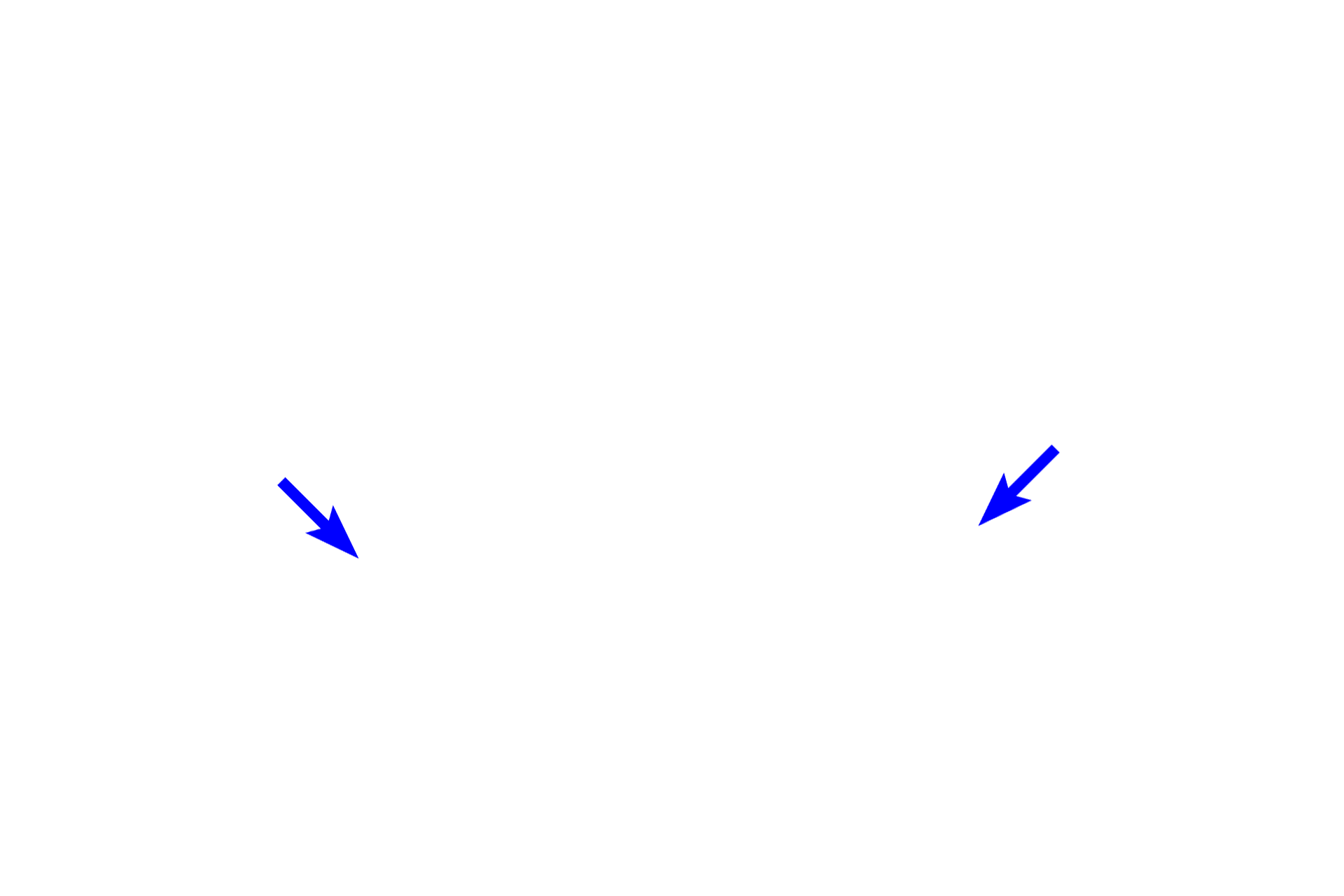  - Tooth bud <p>The dental lamina forms a horseshoe-shaped epithelial ridge over the developing mandible and maxilla.  Localized proliferative activity in the ridge produces a series of epithelial ingrowths (buds) into the ectomesenchyme at sites corresponding to the positions of the future deciduous teeth.  The dental lamina connects the developing tooth bud to the epithelium of the oral cavity. From this point, tooth development proceeds in four stages: bud, cap, bell and crown.</p>

