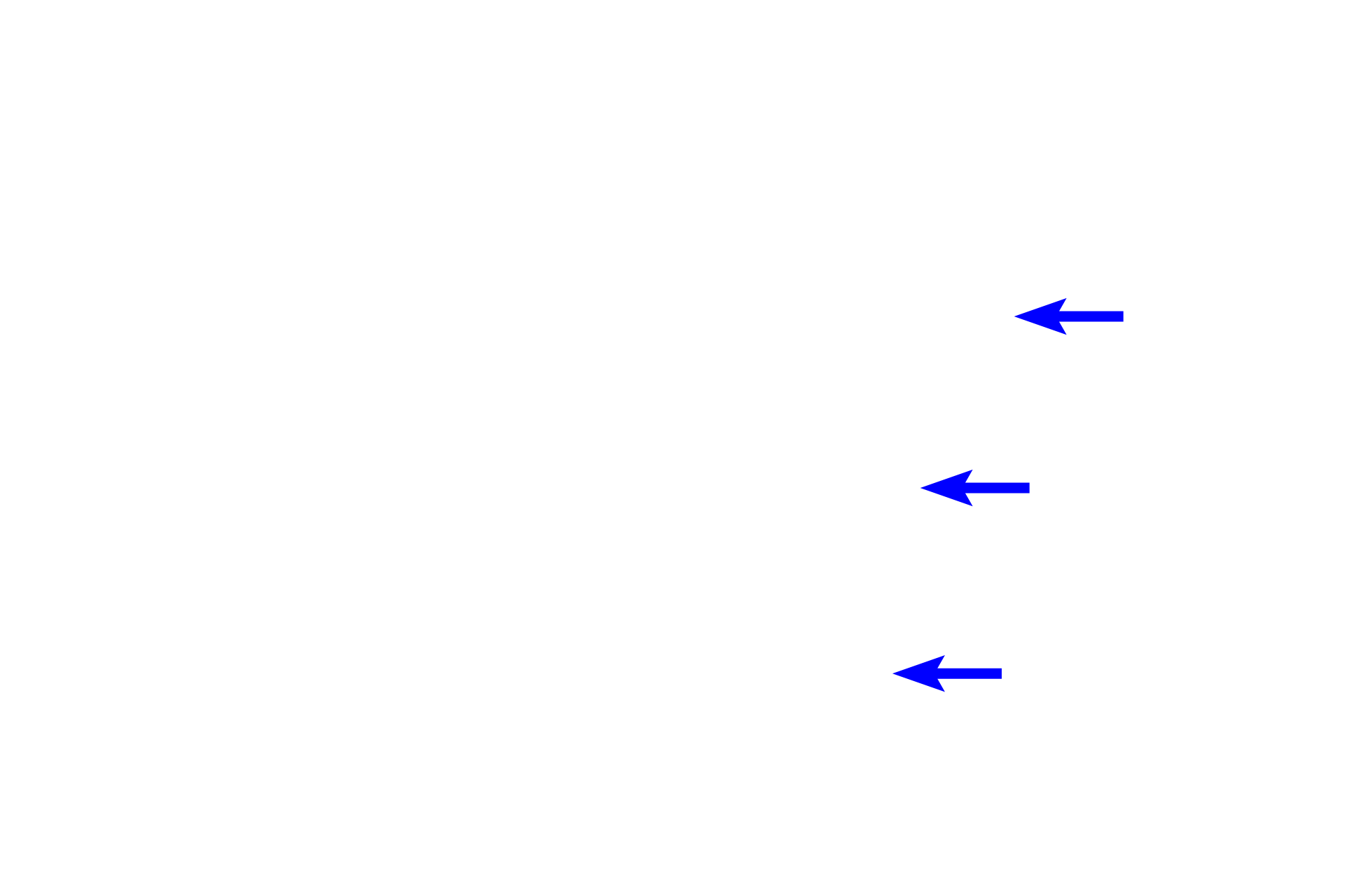  - Bone <p>This spicule demonstrates less calcified cartilage and a higher proportion of bone. The presence of osteoclasts in the endosteum indicates that bone is being broken down and thus this spicule is located in the zone of resorption. </p>
