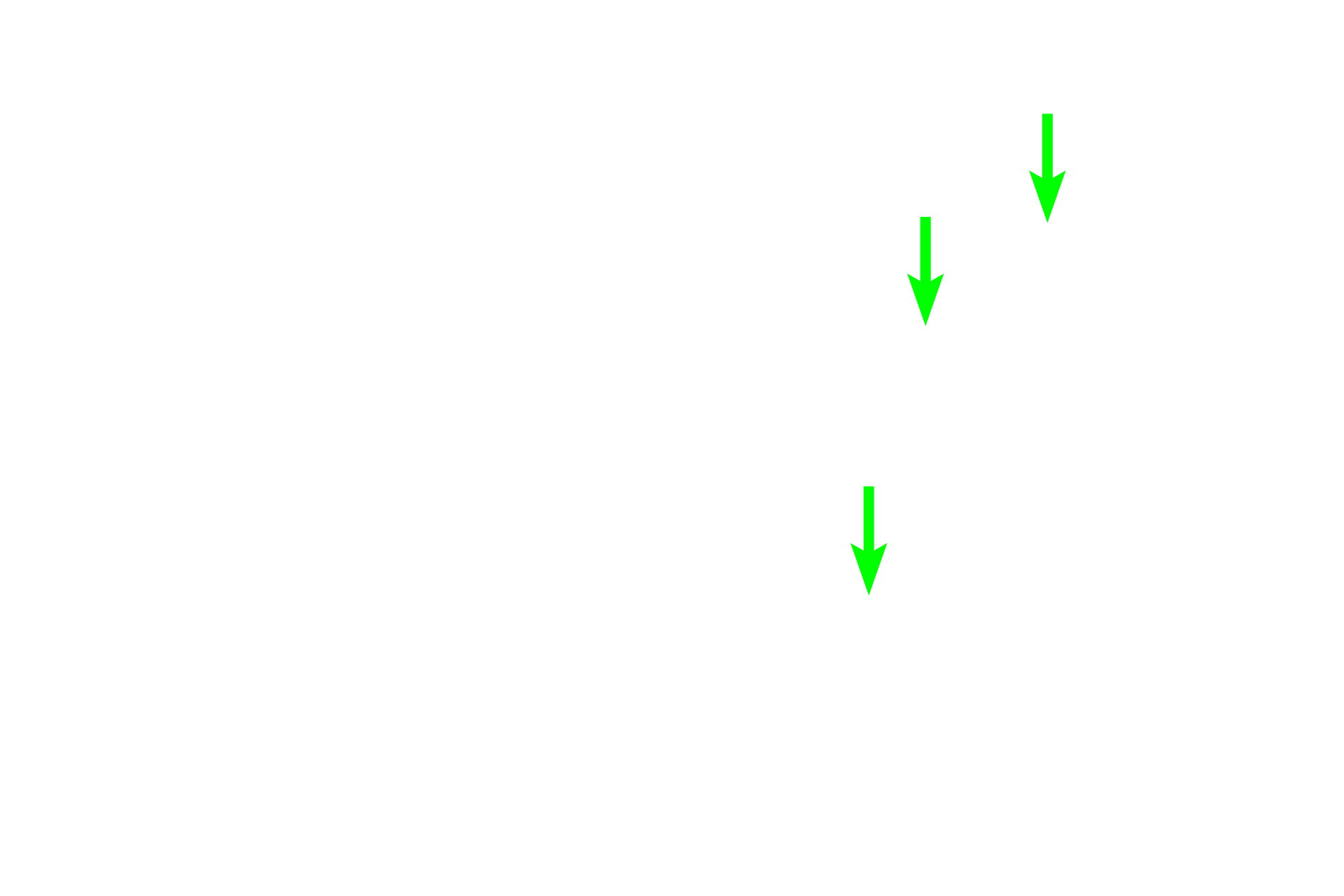  - Calcified cartilage <p>This spicule demonstrates less calcified cartilage and a higher proportion of bone. The presence of osteoclasts in the endosteum indicates that bone is being broken down and thus this spicule is located in the zone of resorption. </p>
