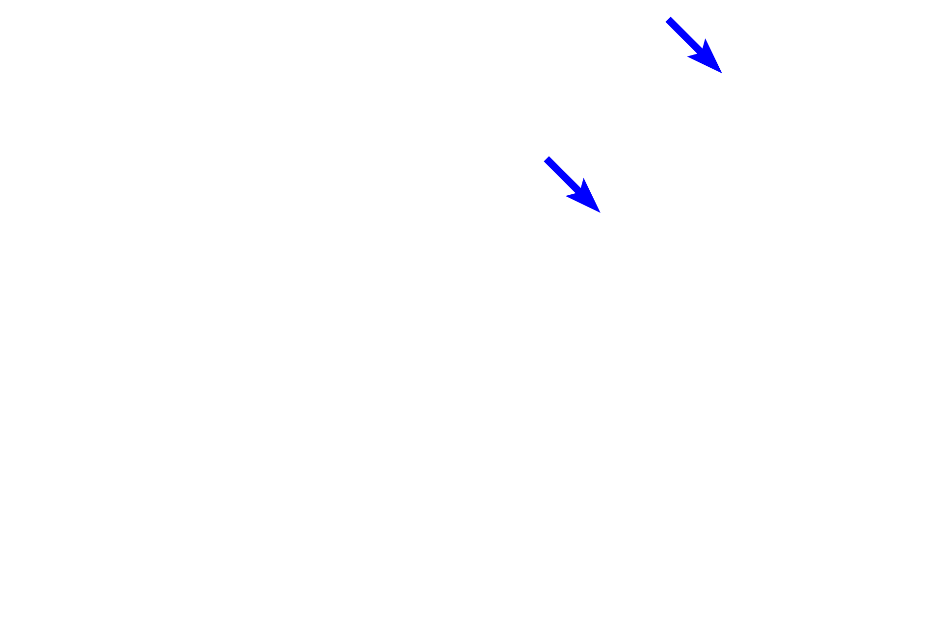  - Osteoclasts <p>This spicule demonstrates less calcified cartilage and a higher proportion of bone. The presence of osteoclasts in the endosteum indicates that bone is being broken down and thus this spicule is located in the zone of resorption. </p>
