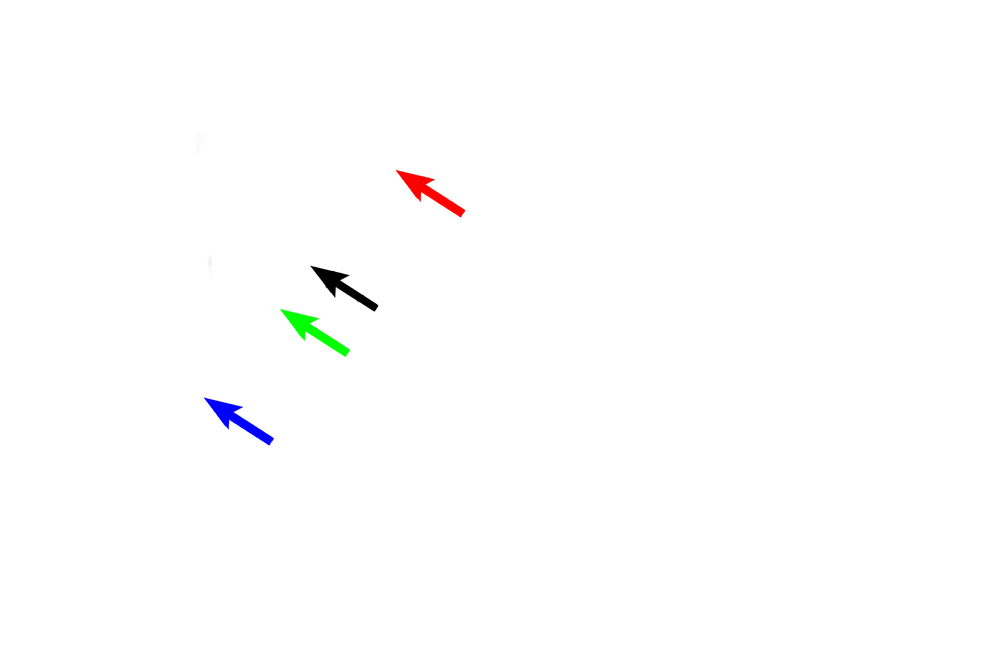  - Membranous labyrinth > <p>The membranous labyrinth is a series of ducts and sacs that are suspended in the osseous labyrinth and are filled with endolymph (orange fill). The utricle (black arrow) and saccule (green arrow) are suspended in the vestibule. A semicircular duct (red arrow) is suspended in each of the three semicircular canals. The cochlear duct (blue arrow) is suspended in the cochlea.</p>
