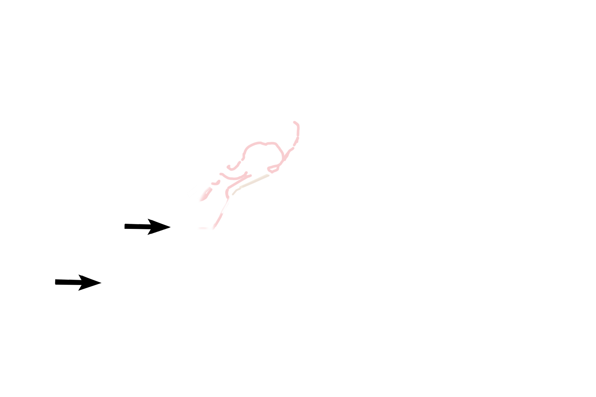 Eustachian tube > <p>The middle ear, or tympanic cavity, is an air-filled space in the temporal bone. Three auditory ossicles span the cavity between the tympanic membrane and an opening in the wall of the inner ear, the oval window. The middle ear communicates with the pharynx anteriorly through the auditory, or Eustachian, tube.</p>
