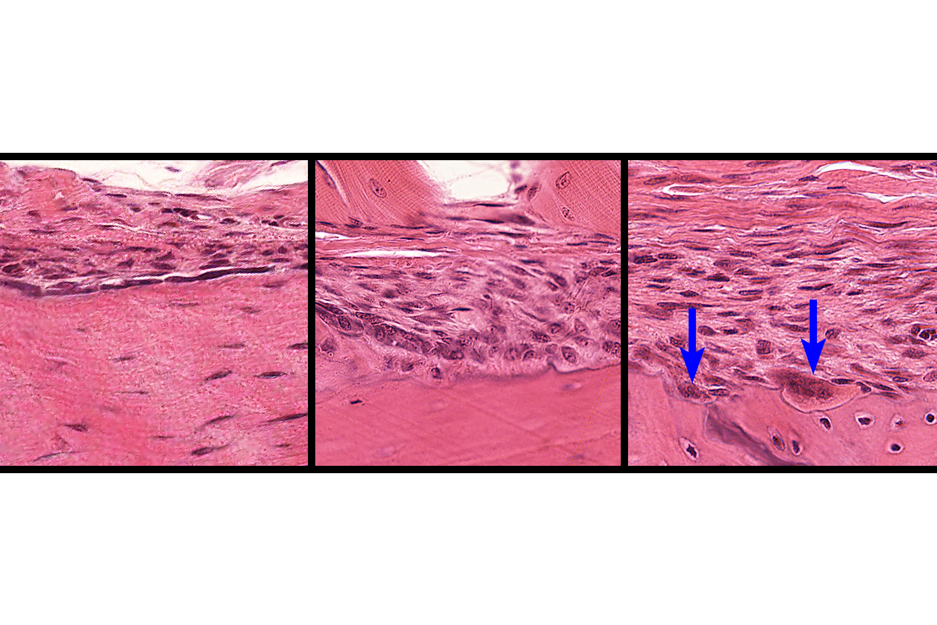 Cells of the endosteum and periosteum > <p>In non-active regions of both periosteum and endosteum, bone lining cells are most prevalent (left panel). These cells also include osteoprogenitor cells. In areas of active bone deposition (center panel), cuboidal osteoblasts are present; areas of bone resorption (right panel) are marked by the presence of osteoclasts (arrows).  </p>
