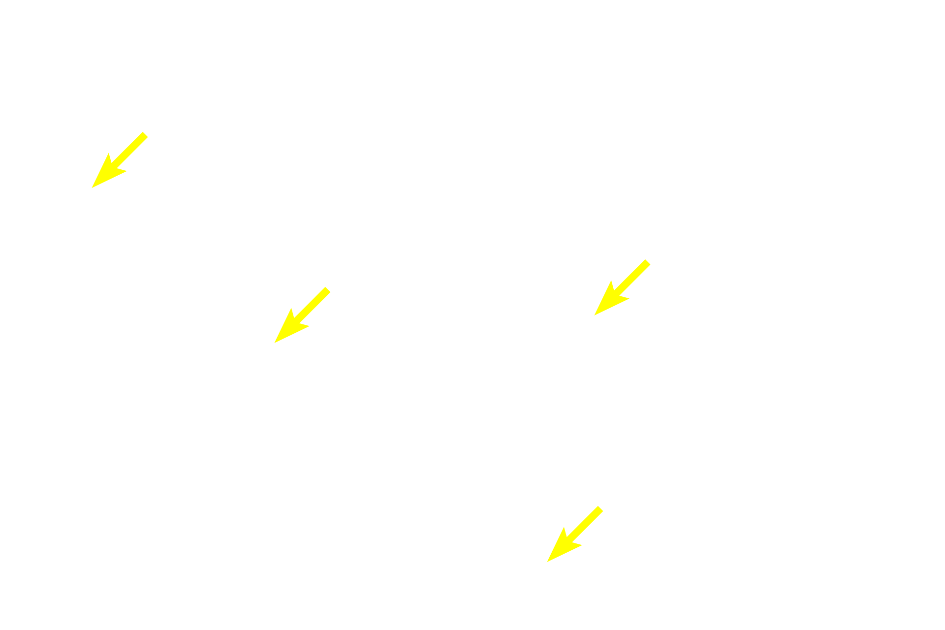 Diffuse lymphoid tissue <p>The diffuse lymphoid tissue shown here is located in the lamina propria of the small intestine. Diffuse lymphoid tissue is a component of MALT and consists mostly of scattered lymphocytes as well as macrophages that filter tissue fluid. Small intestine, 200x</p>
