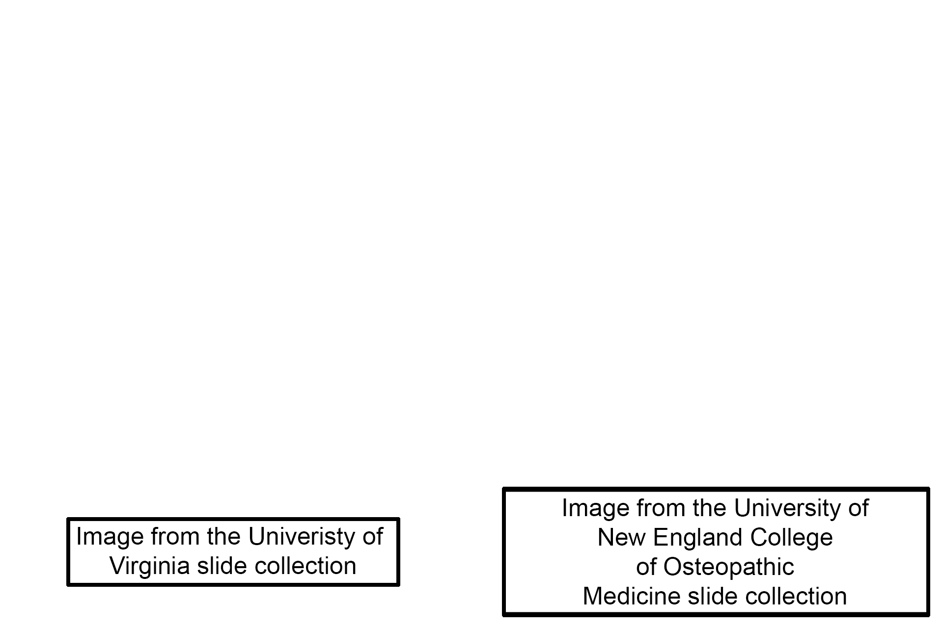 Image sources > <p>These images were taken of slides from the University of Virginia (l) and the University of New England College of Osteopathic Medicine (r) collections.</p>

