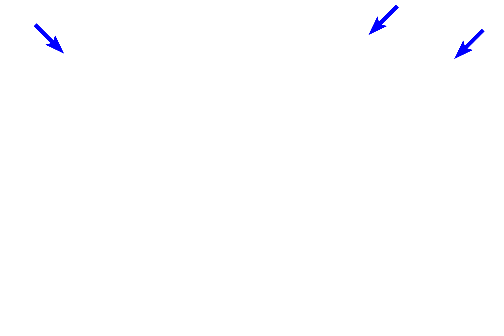 Epithelium >  <p>The pharyngeal tonsil or adenoid is located in the roof of the pharynx and is covered by a ciliated, pseudostratified columnar epithelium similar to that seen in the respiratory system.</p>
