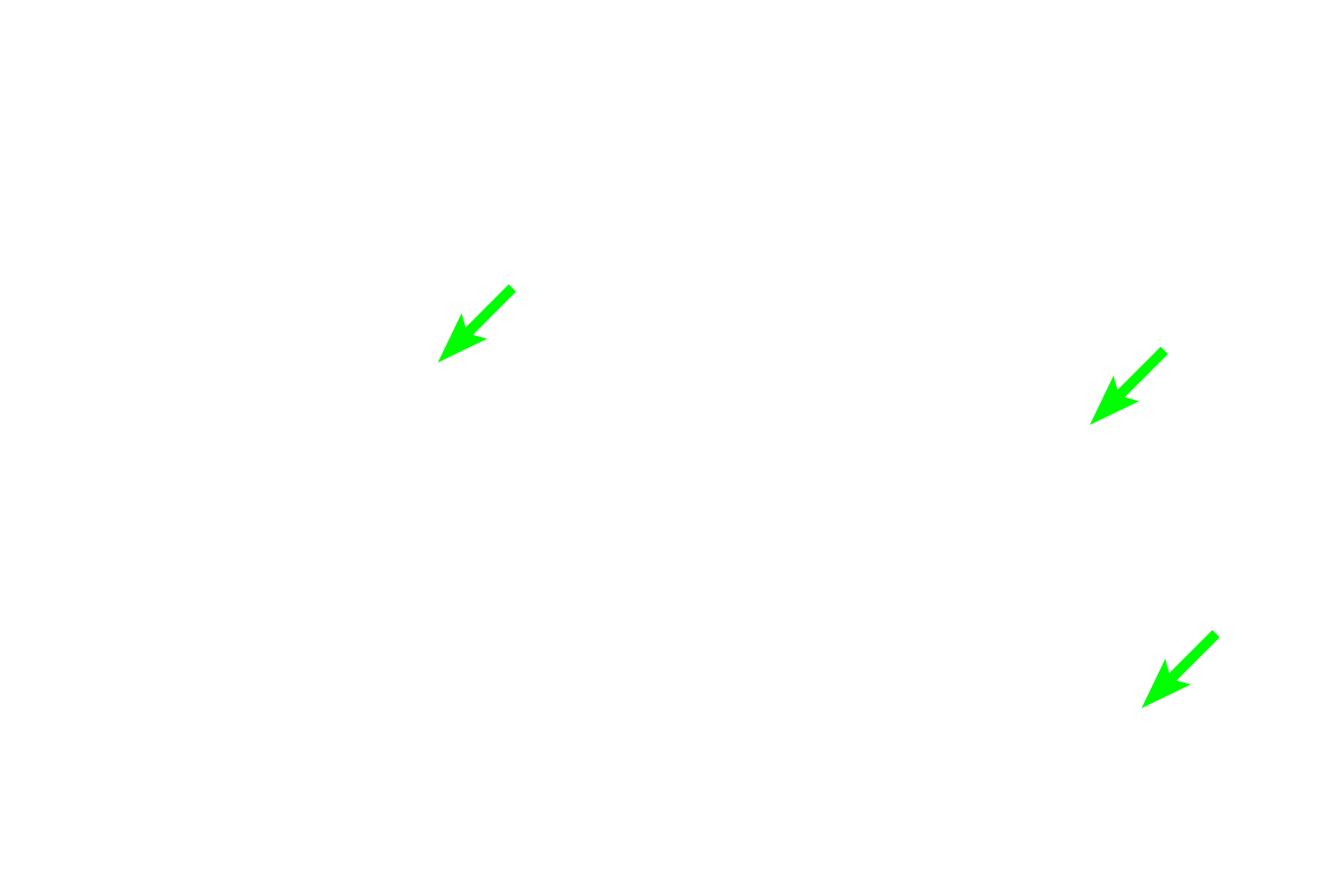 Osteoclasts <p>These images show osteoclasts on the surface of compact bone. Multinucleated osteoclasts are located in Howship’s lacunae that result from resorption of the bone matrix adjacent to the cell. The osteoclast on the left is located in the periosteum; the cells on the right are located in the endosteum. 800x, 600x </p>
